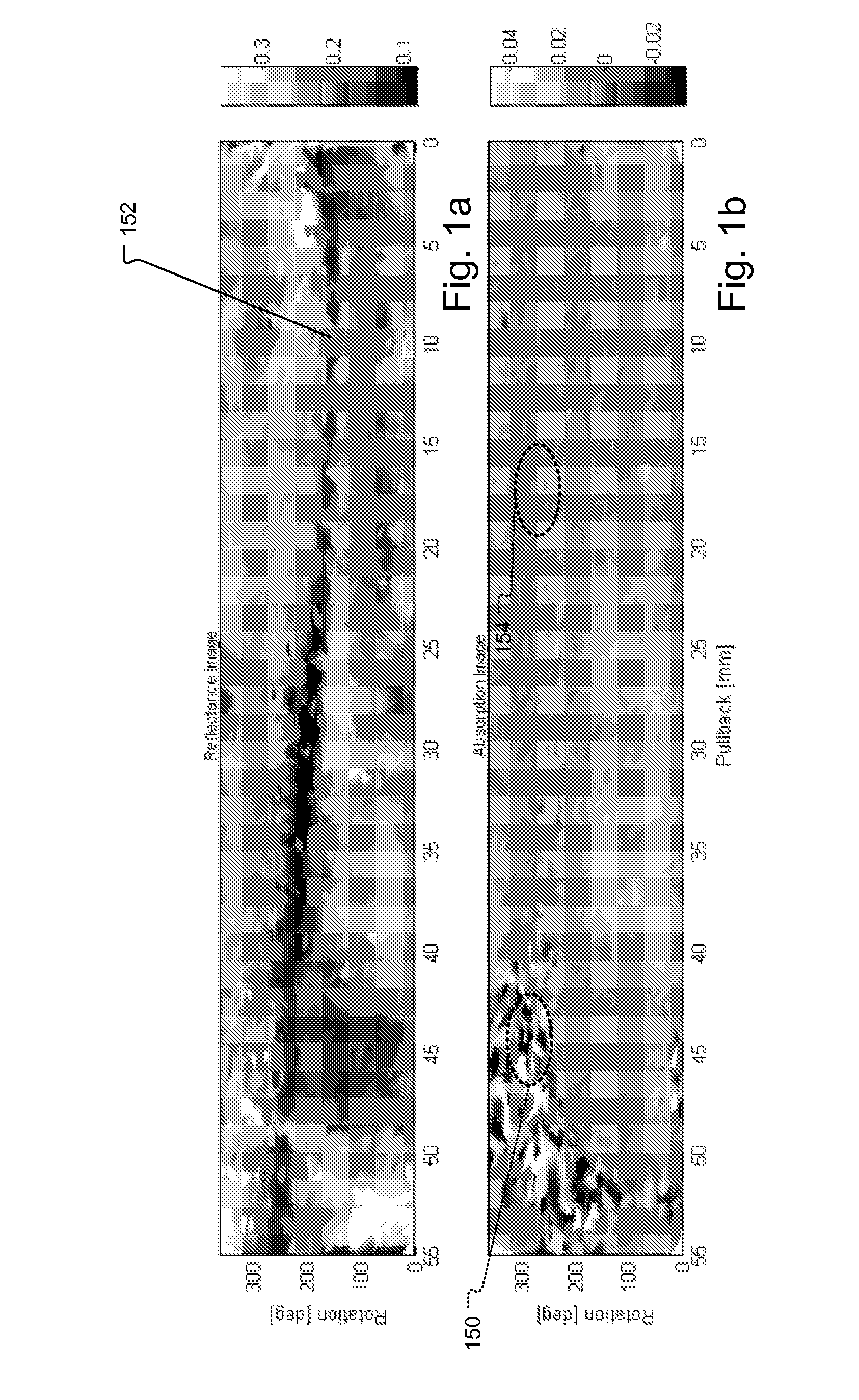 Method and System for Intra Luminal Thrombus Detection