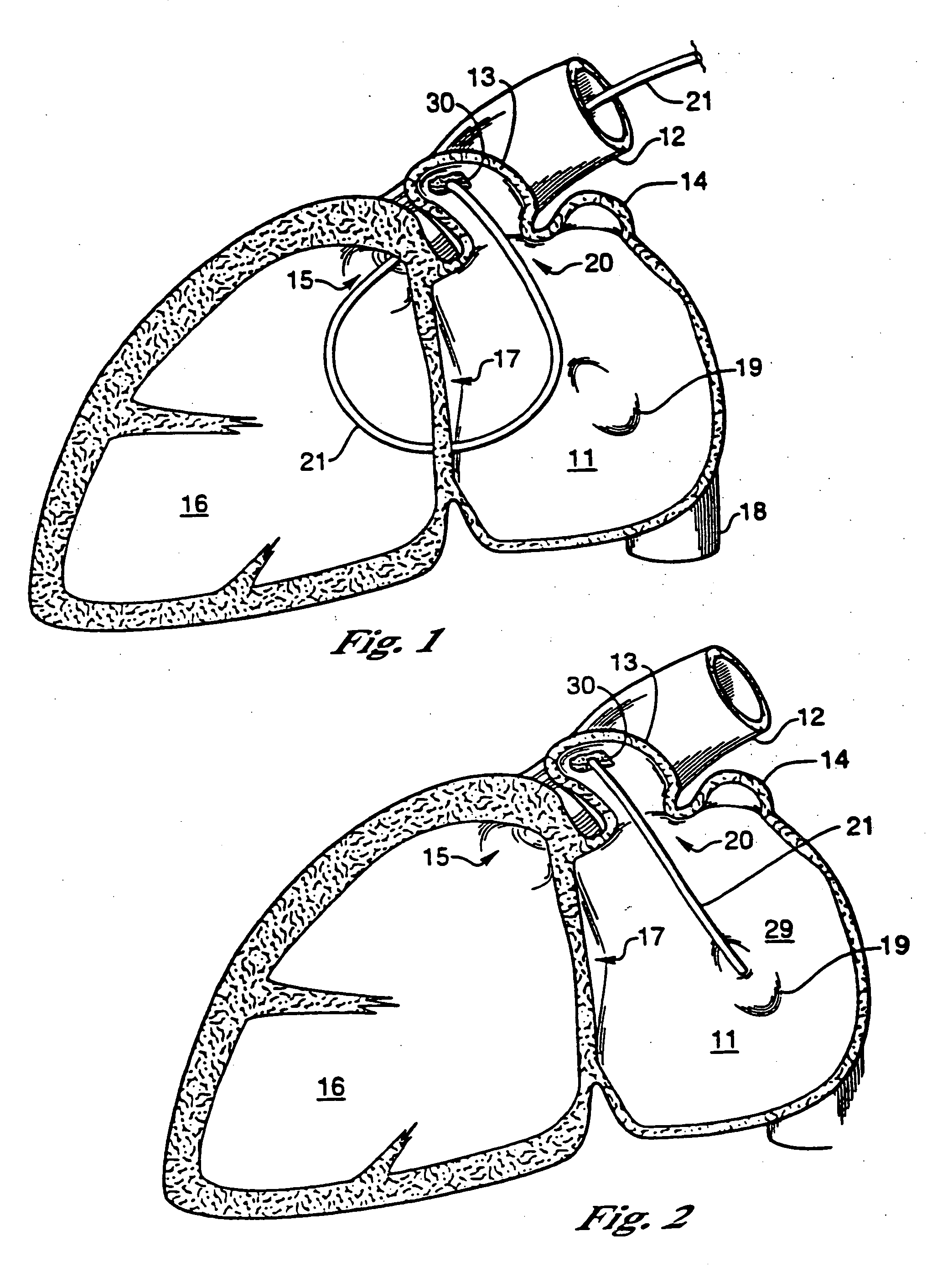 Barrier device for ostium of left atrial appendage