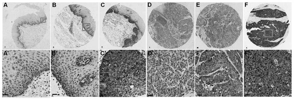 Method for researching influence of tumour-associated antigen p62/IMP2 on esophageal squamous cell carcinoma ESCC