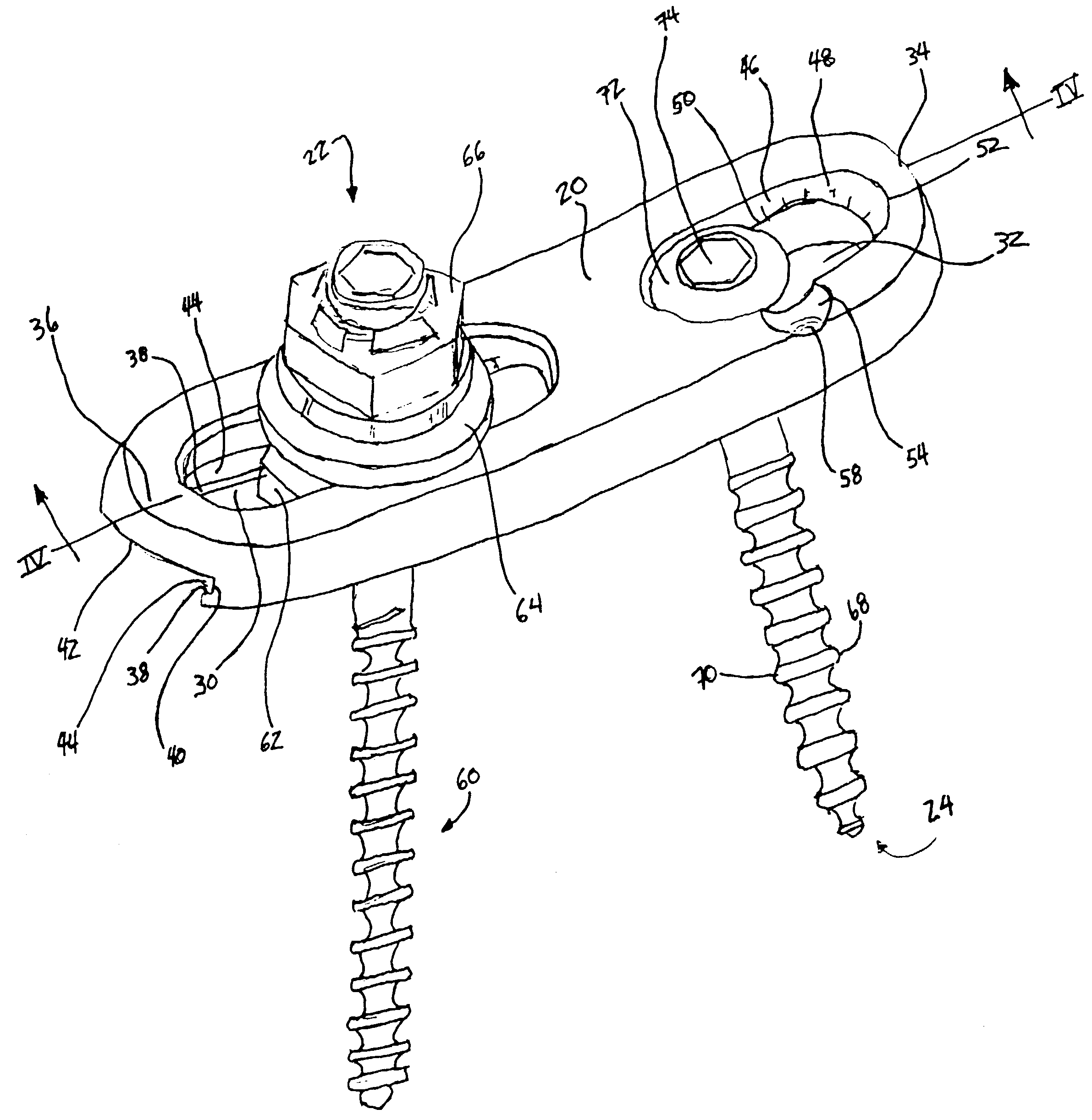 Posterior pedicle screw and plate system and methods