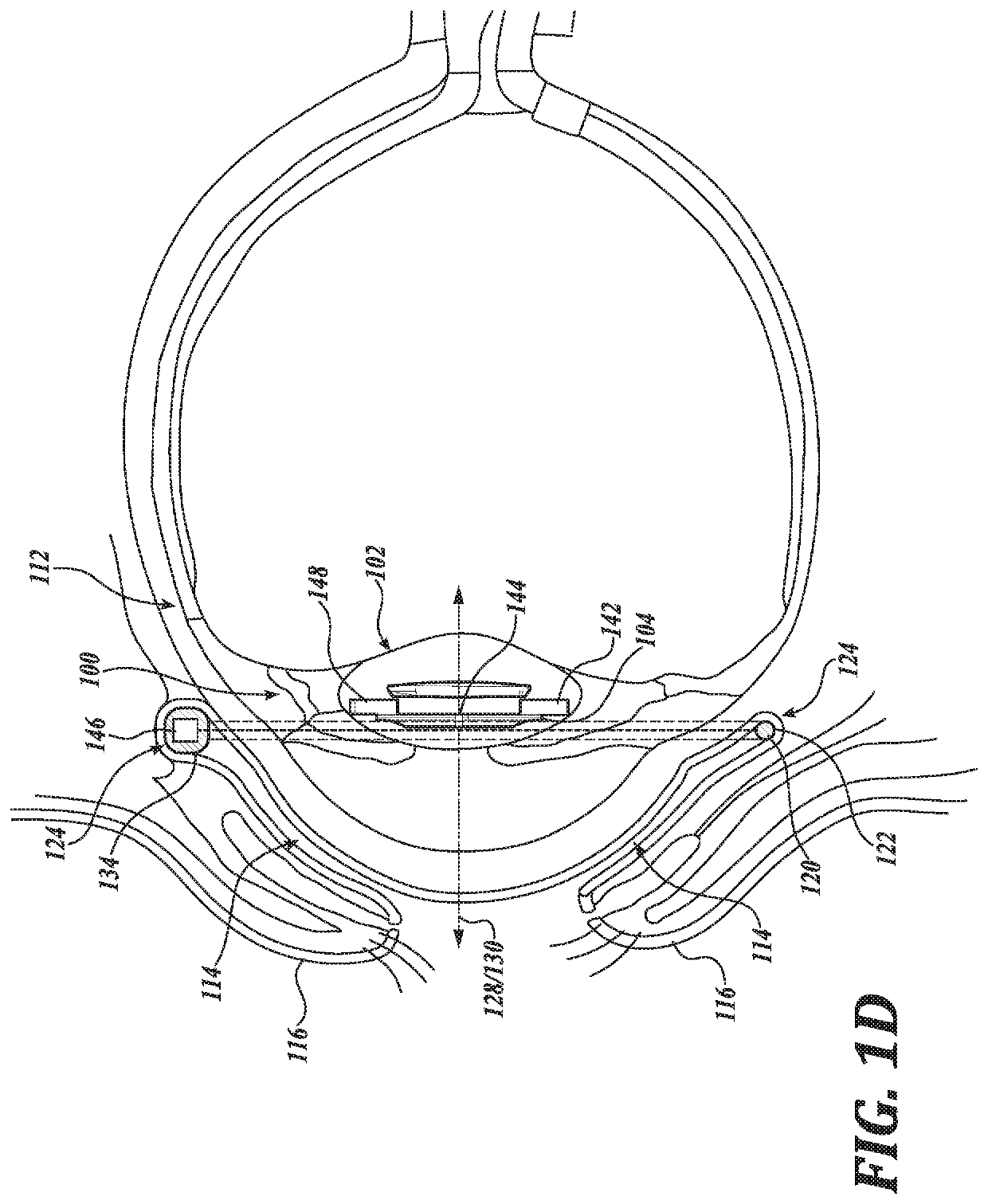 Ophthalmic system including accommodating intraocular lens and remote component and related methods of use