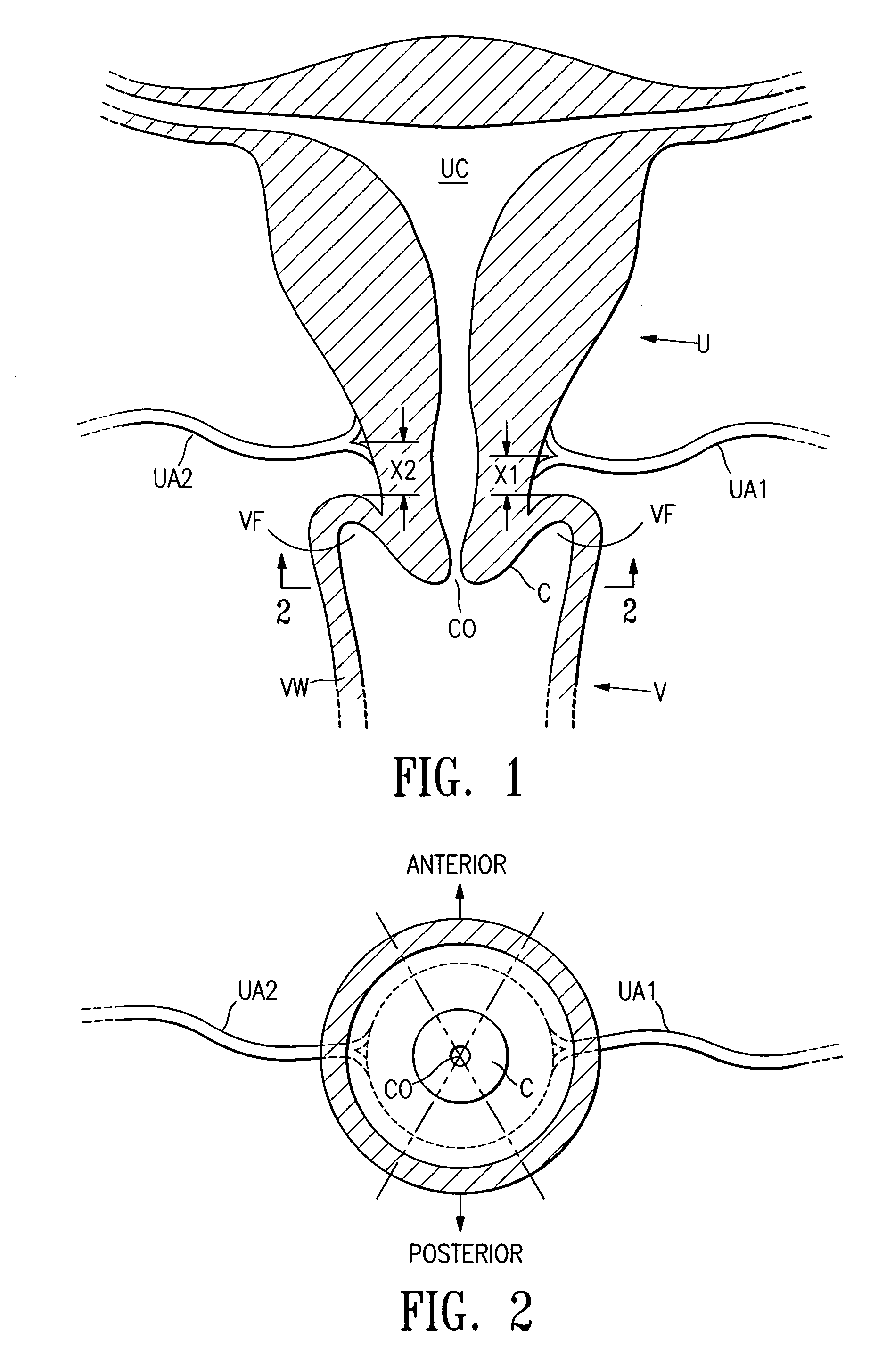 Multi-axial uterine artery identification, characterization, and occlusion pivoting devices and methods