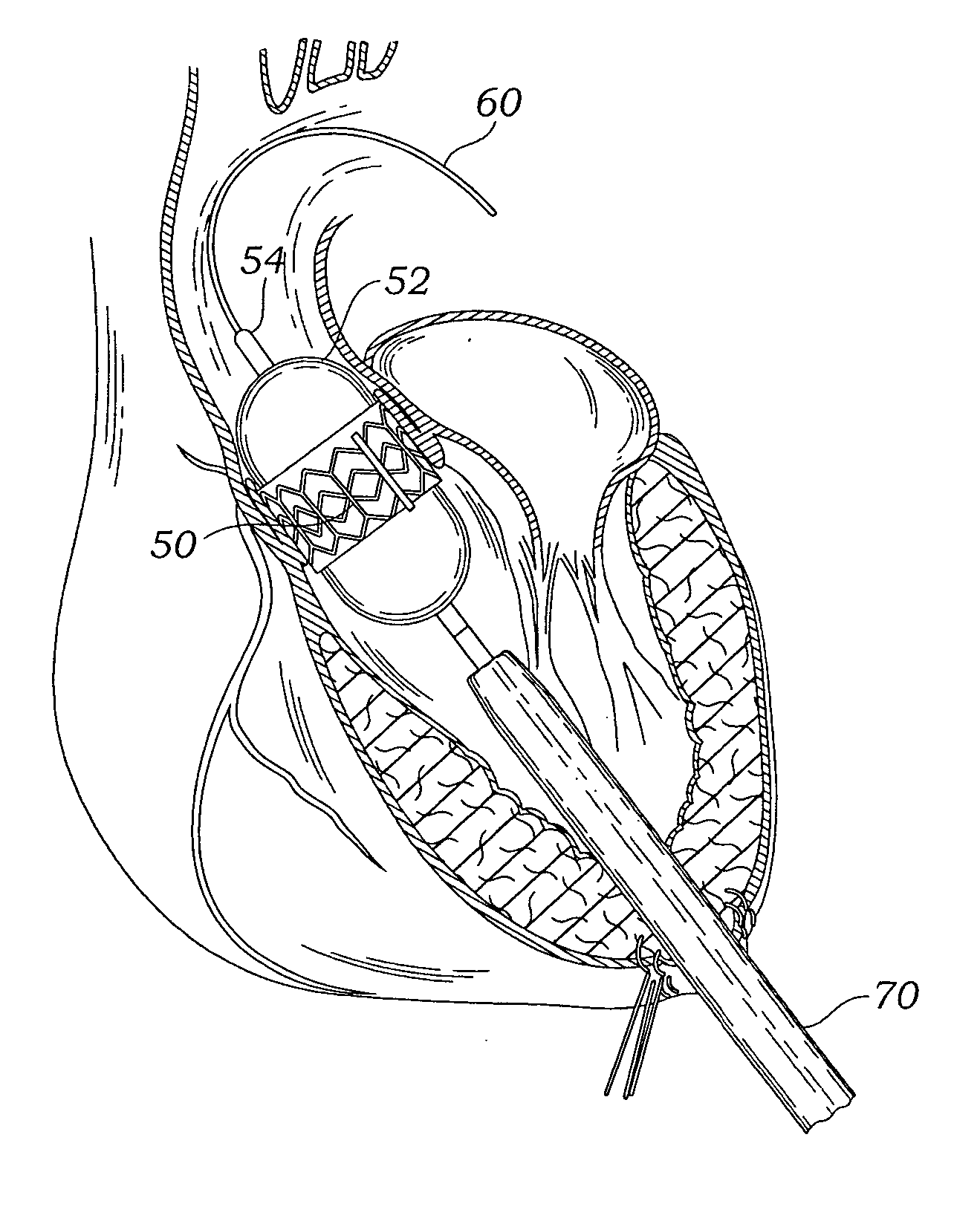 Transapical heart valve delivery system and method