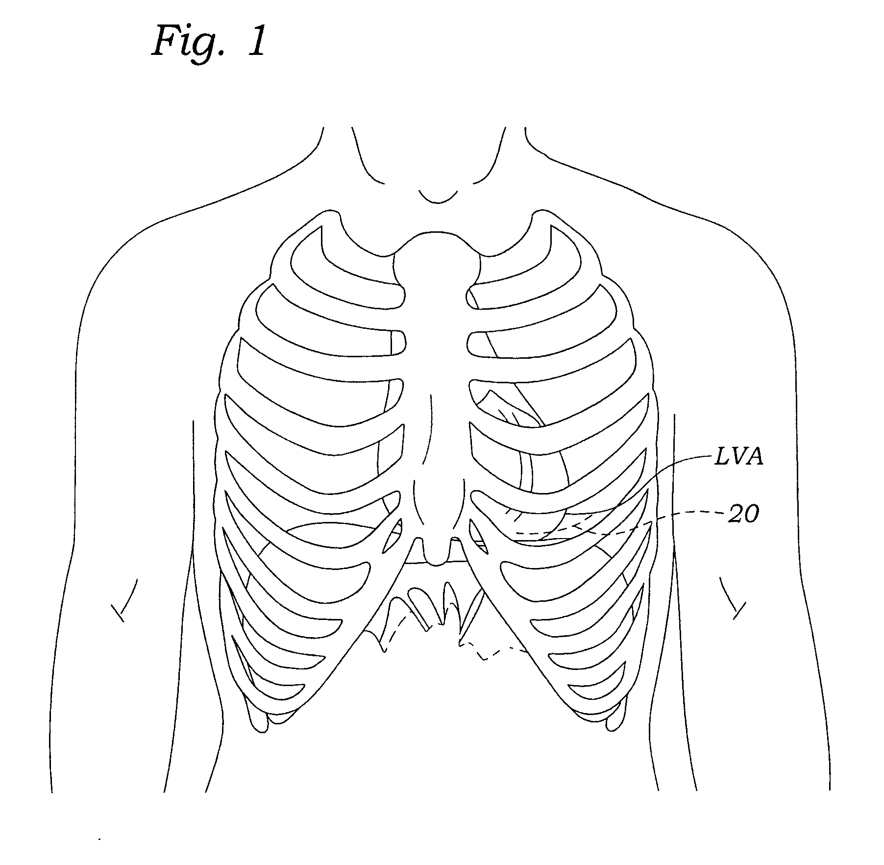 Transapical heart valve delivery system and method