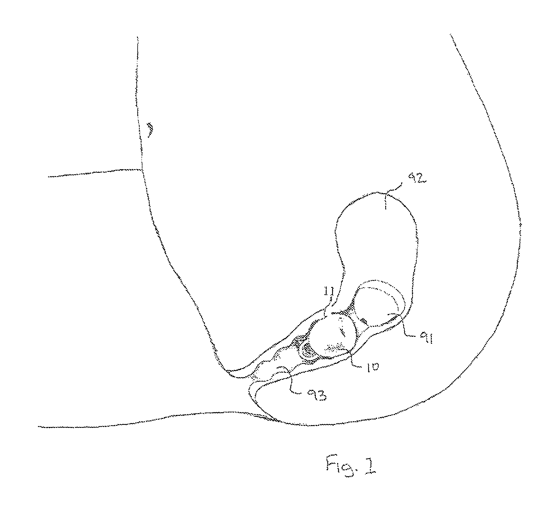 Device and method for menstrual blood collection