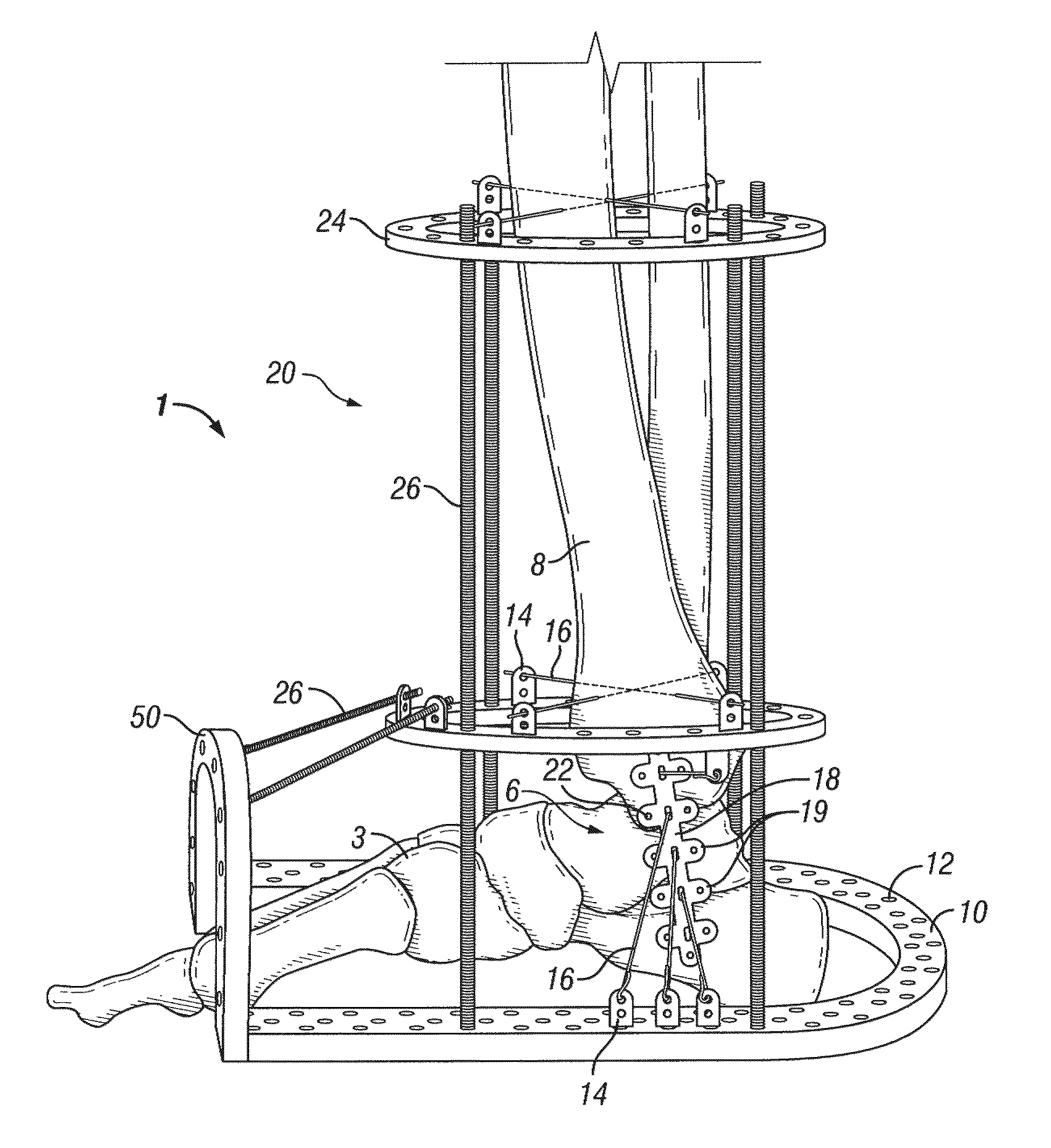 Foot, ankle and lower extremity compression and fixation system and related uses