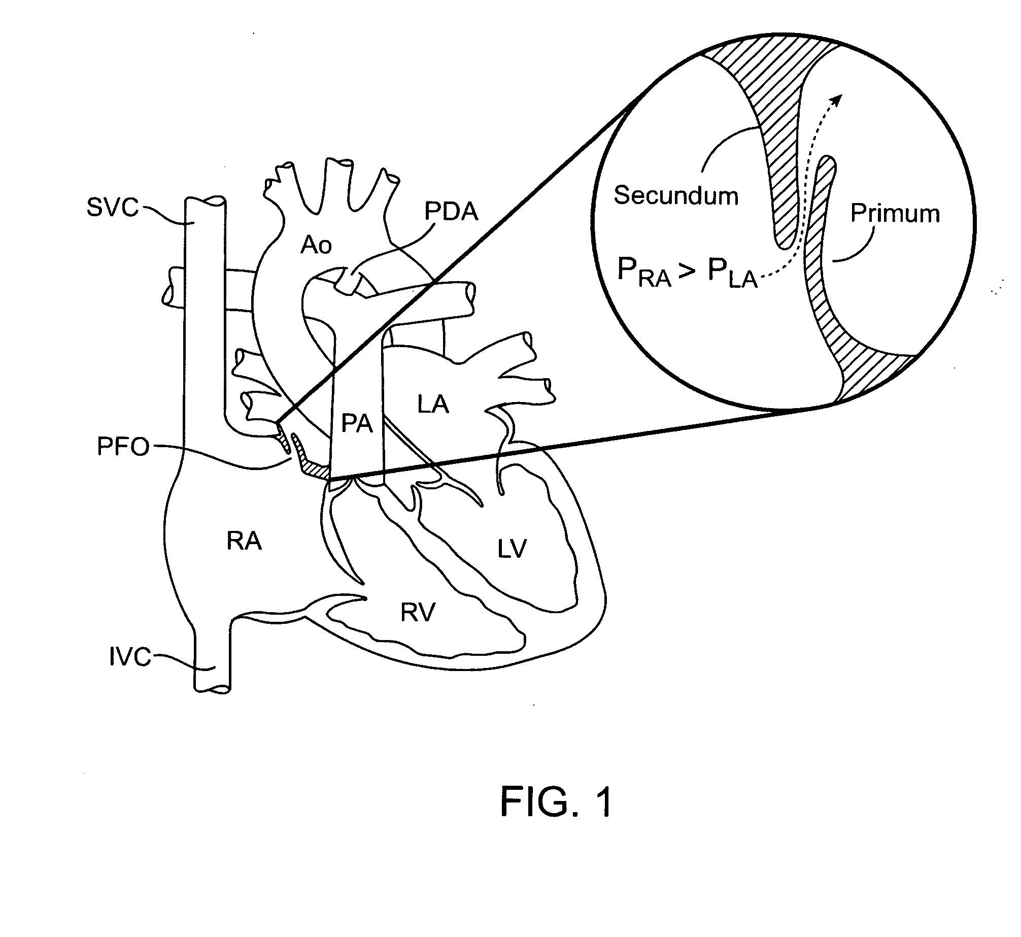 Methods and electrode apparatus to achieve a closure of a layered tissue defect