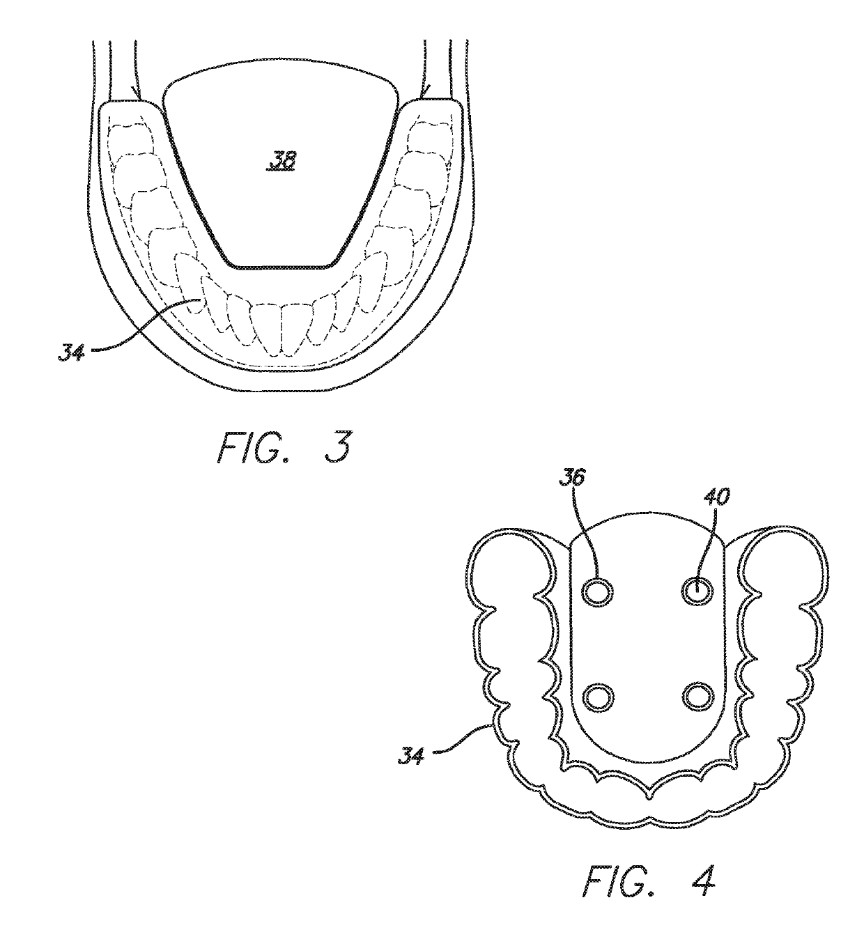 Dental Sleep Apnea Device