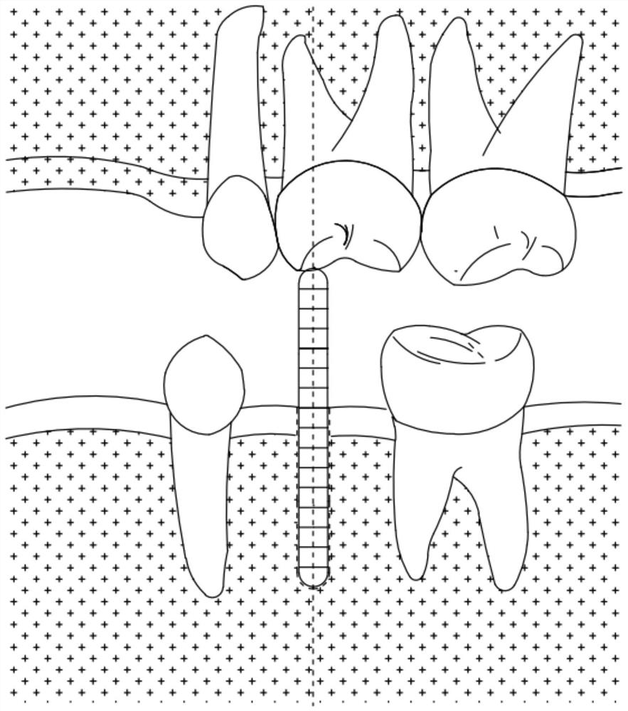 Implant cavity measuring rod and method with restoration guidance under tooth tip dislocation as reference