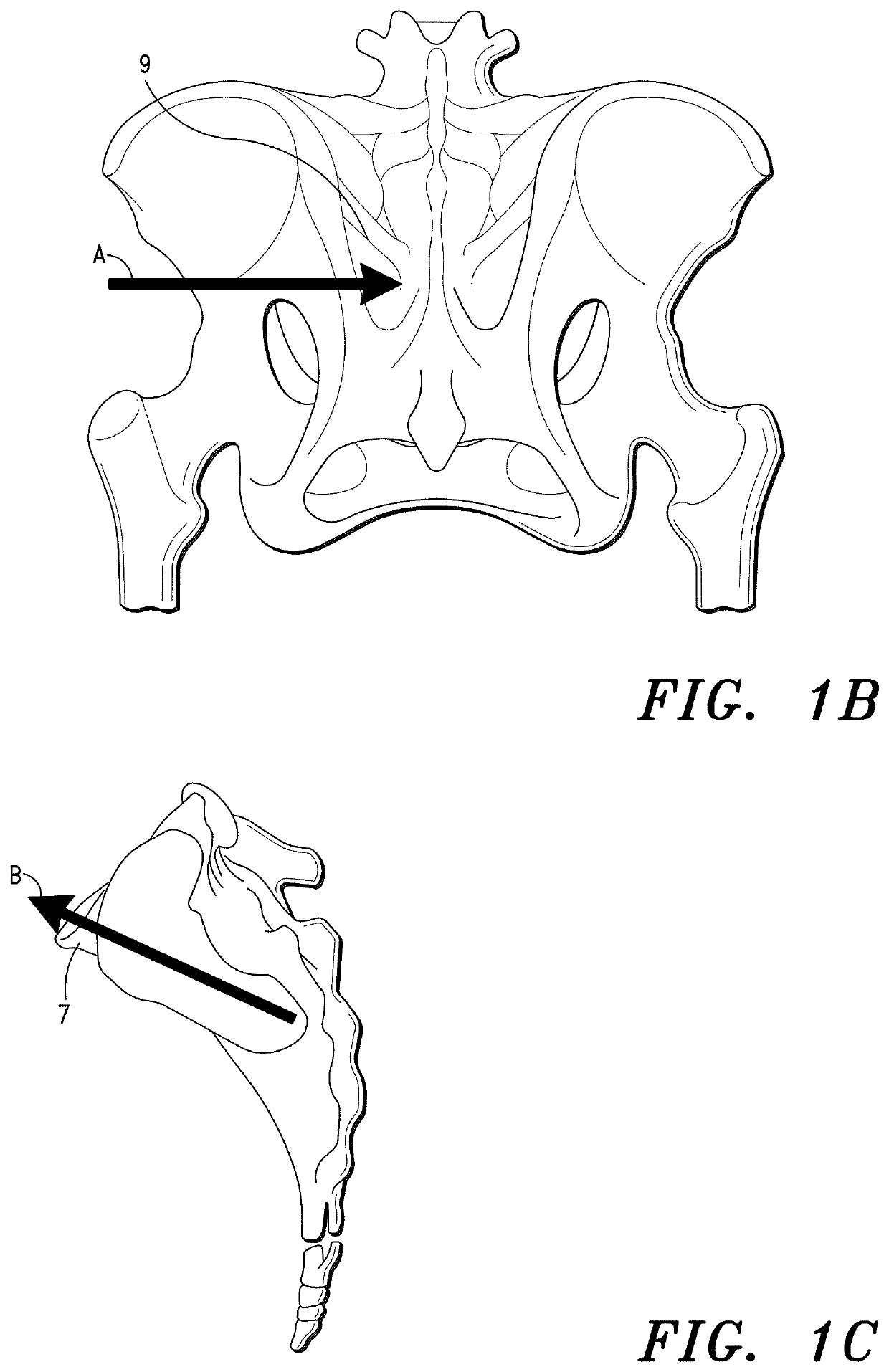 Sacroiliac Joint Stabilization Prostheses