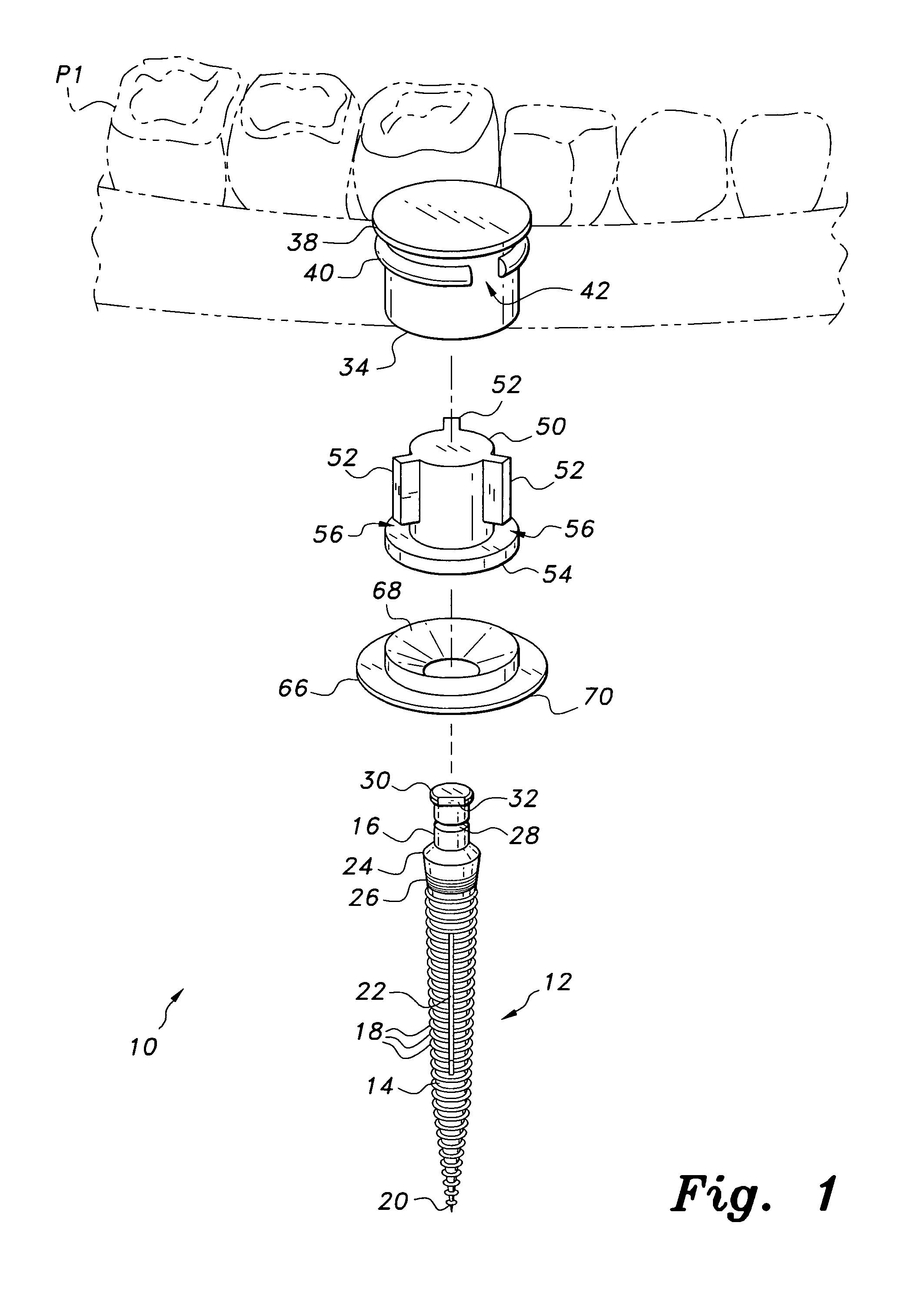 Dental implant system