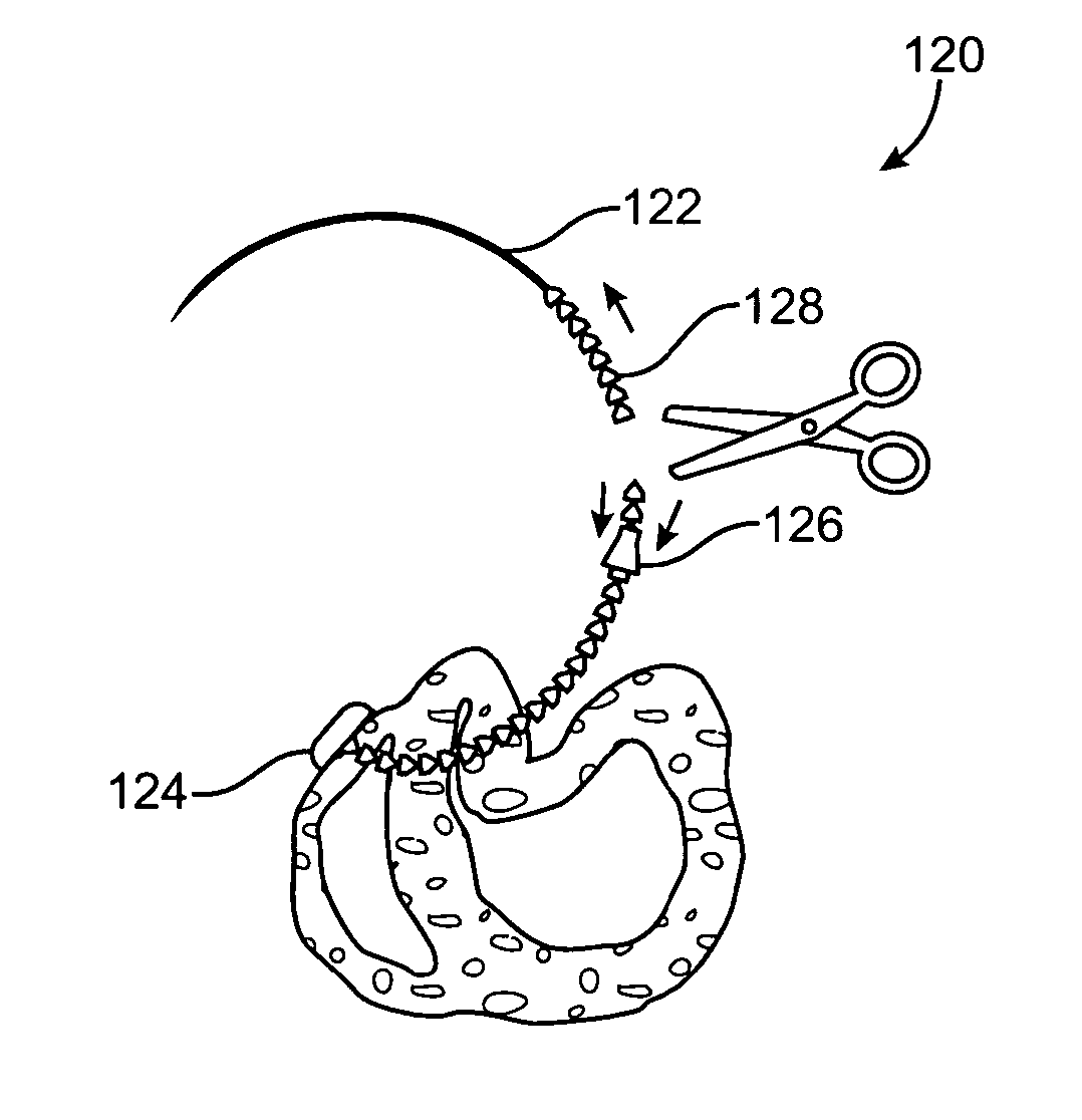 Method and apparatus for closing off a portion of a heart ventricle