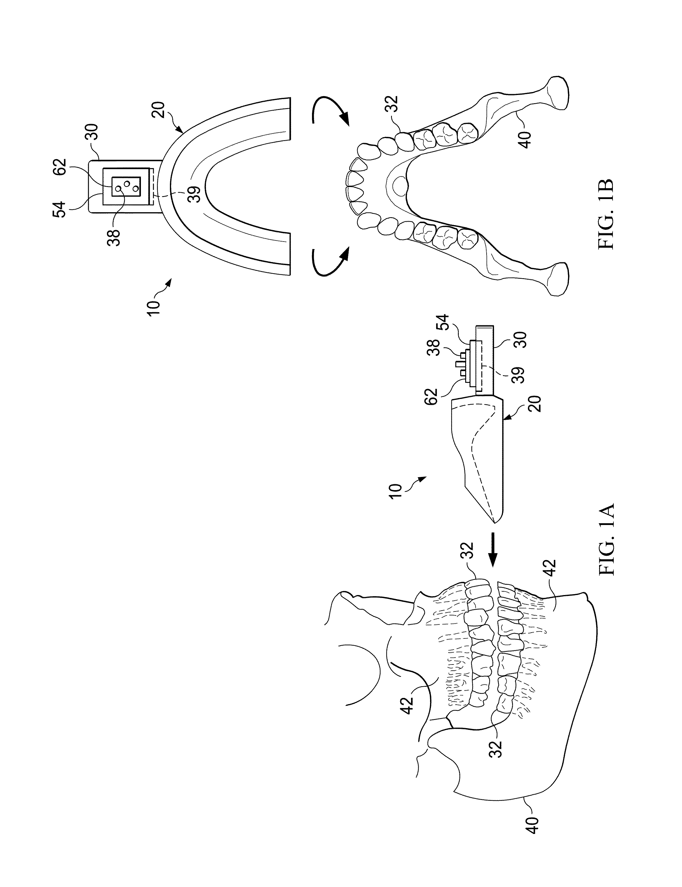 Vibrating orthodontic remodeling device and method thereof