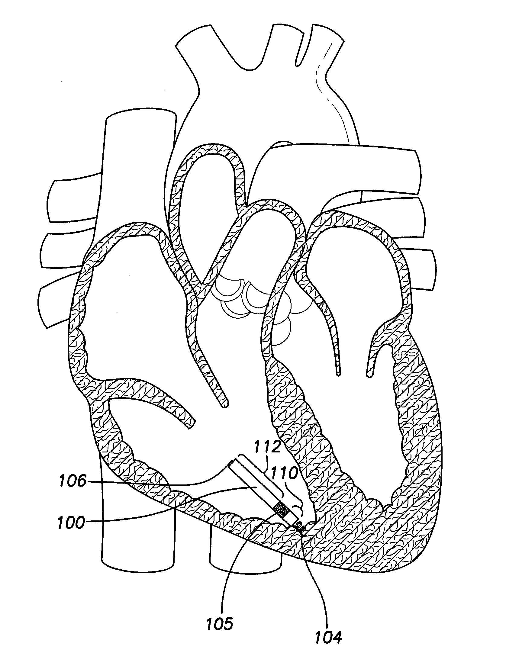 Single chamber leadless intra-cardiac medical device having dual chamber sensing with signal discrimination