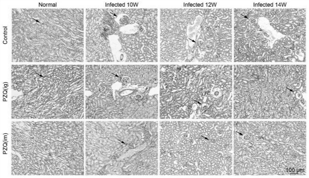 Application of praziquantel in resisting renal fibrosis diseases