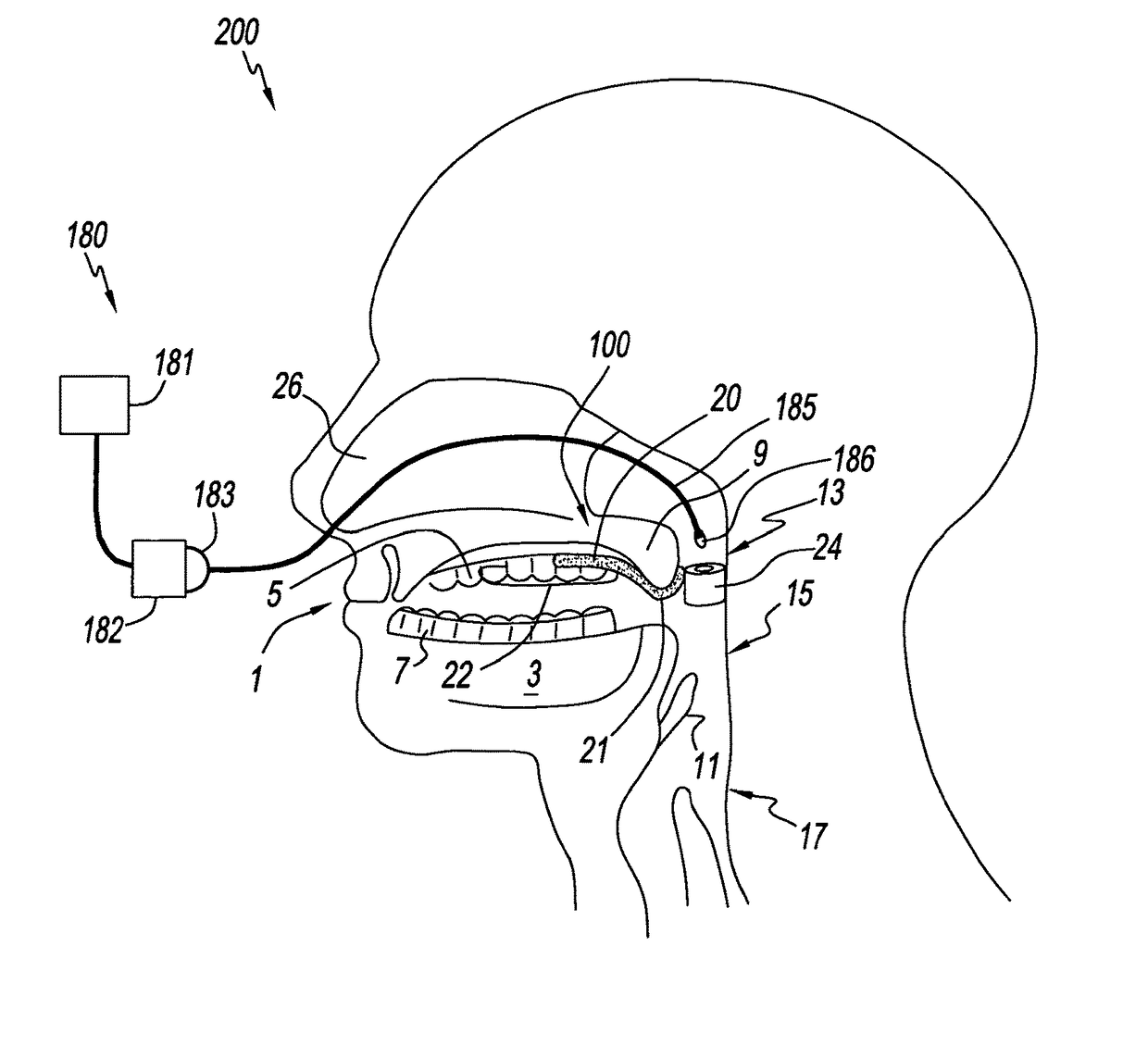 Palate retainer with attached nasopharyngeal airway extender for use in the treatment of obstructive sleep apnea
