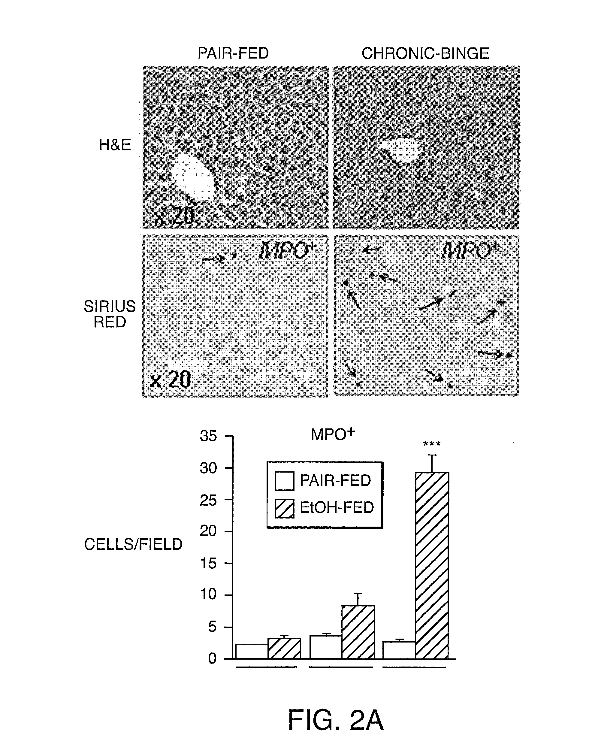 Compositions And Methods For Treating Steatohepatitis, Liver Fibrosis, and Hepatocellular Carcinoma (HCC)