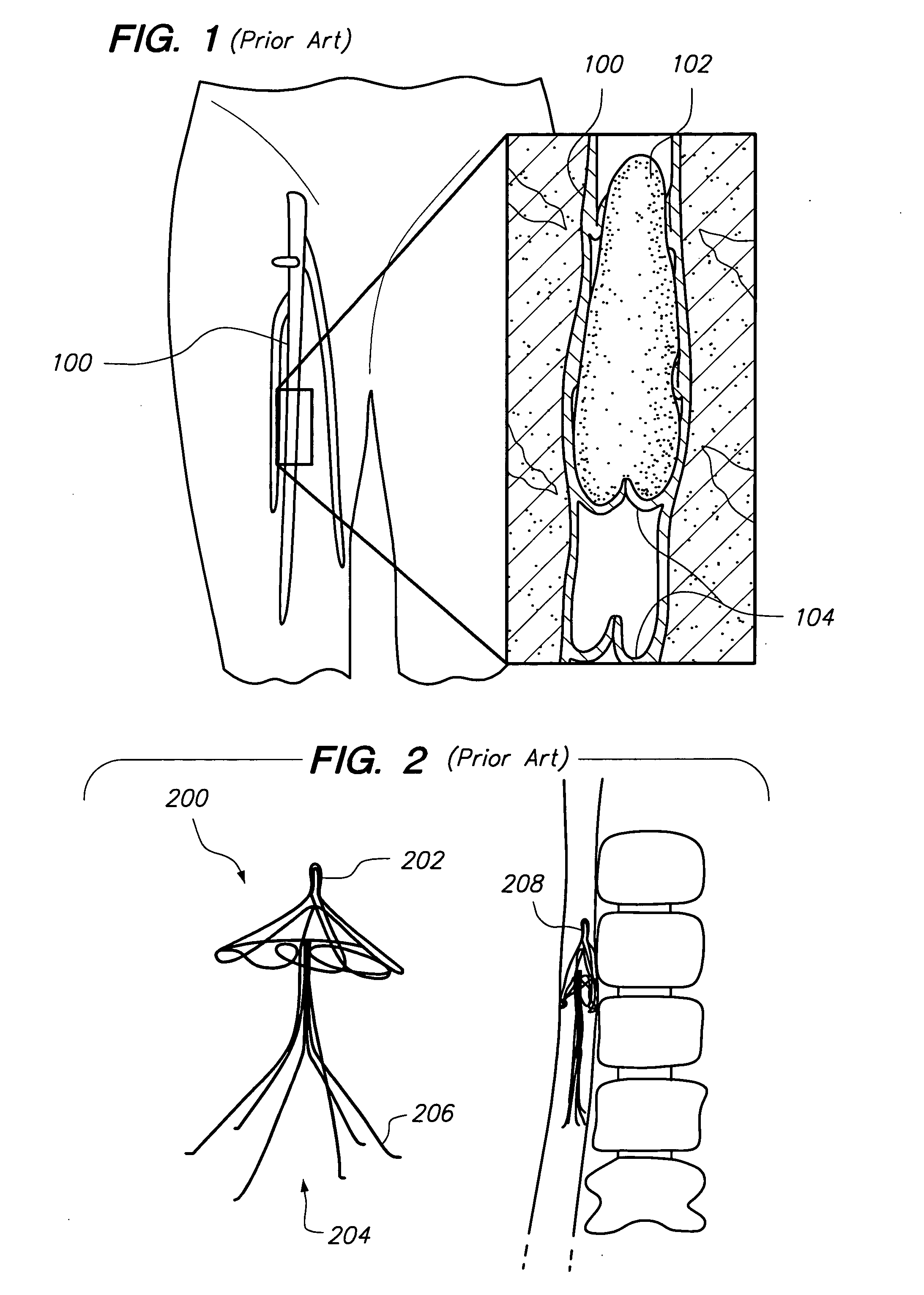 Intravenous deep vein thrombosis filter and method of filter placement