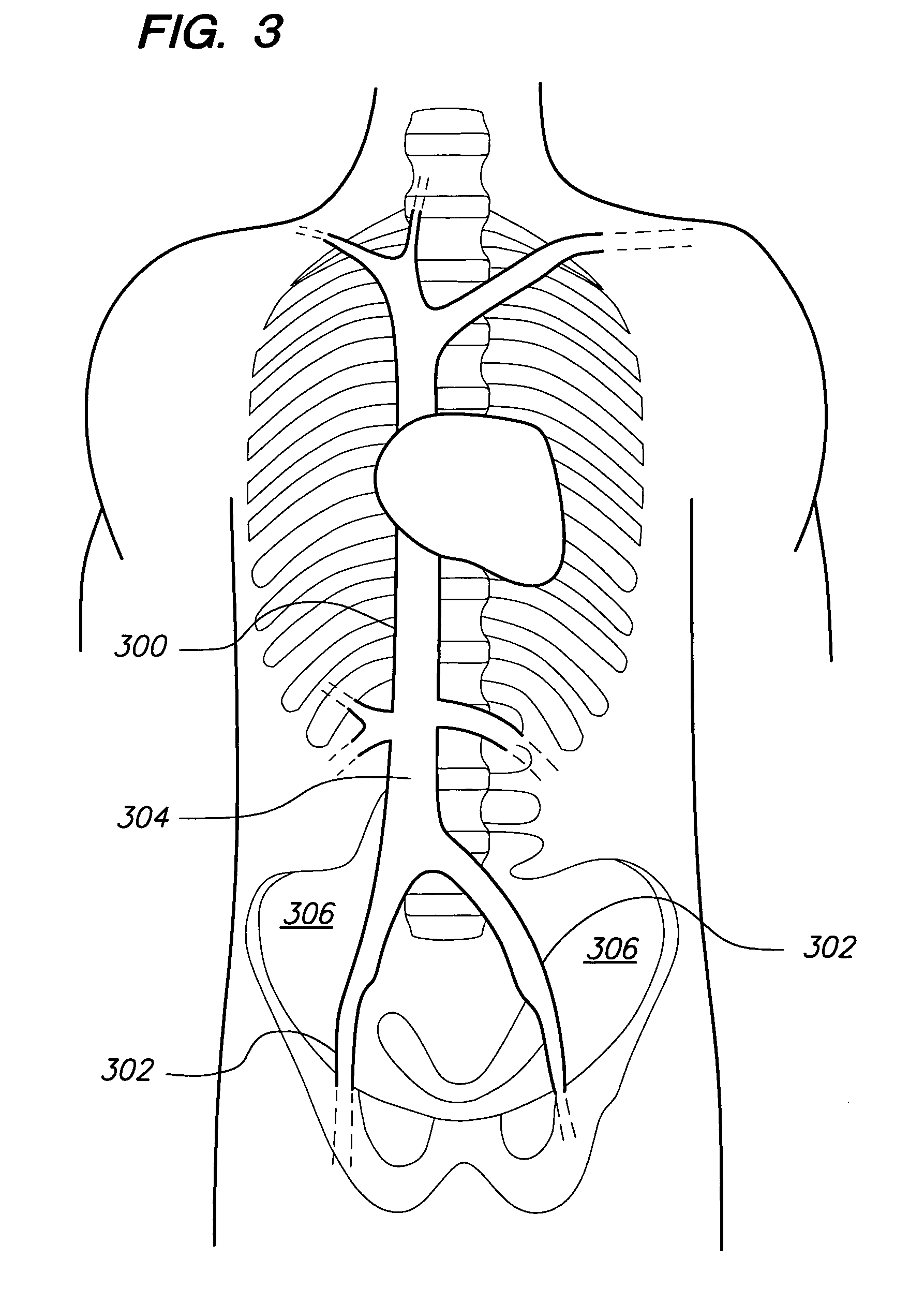 Intravenous deep vein thrombosis filter and method of filter placement
