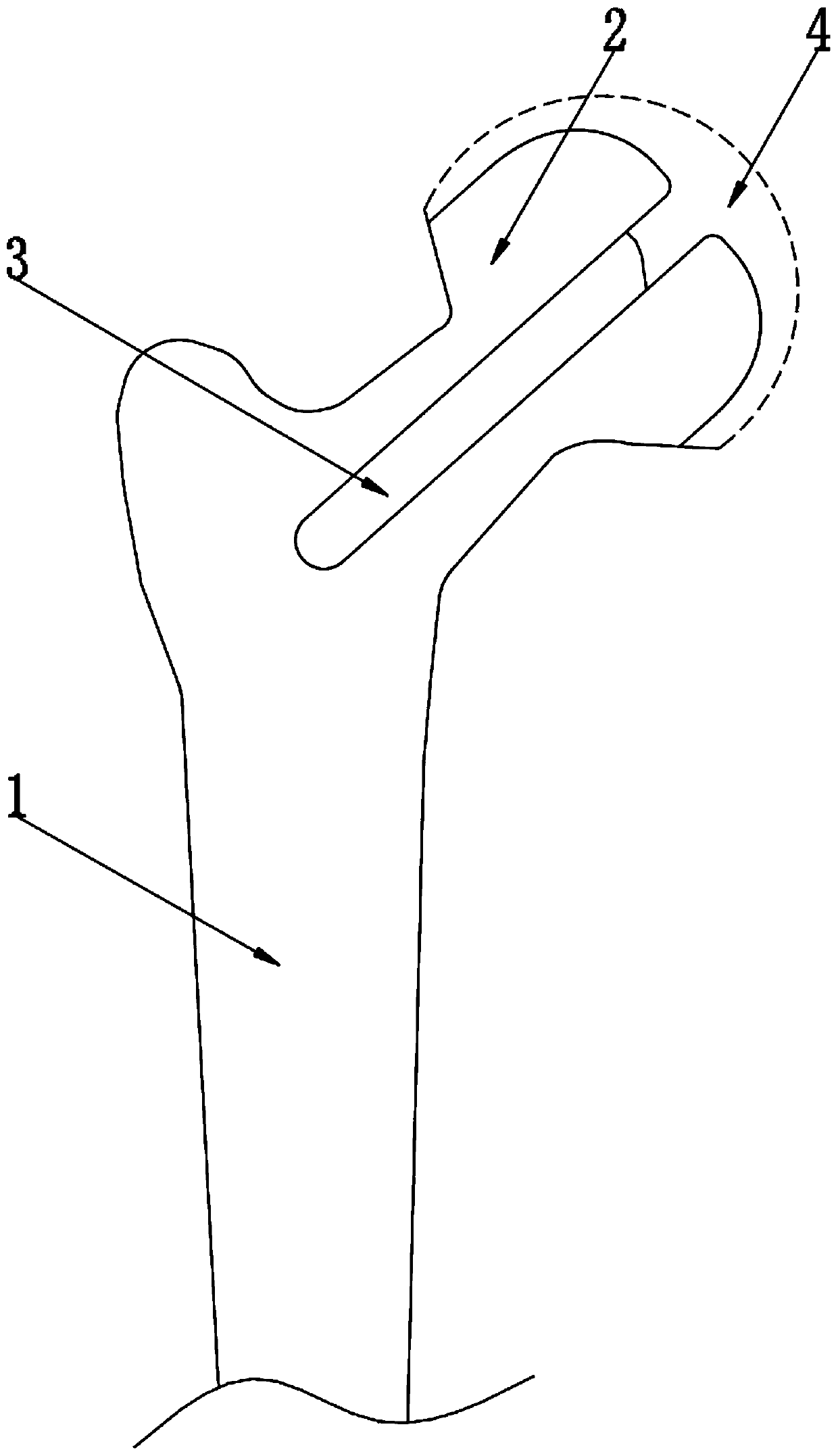 Manufacturing process for surface replacement femoral head and femoral head