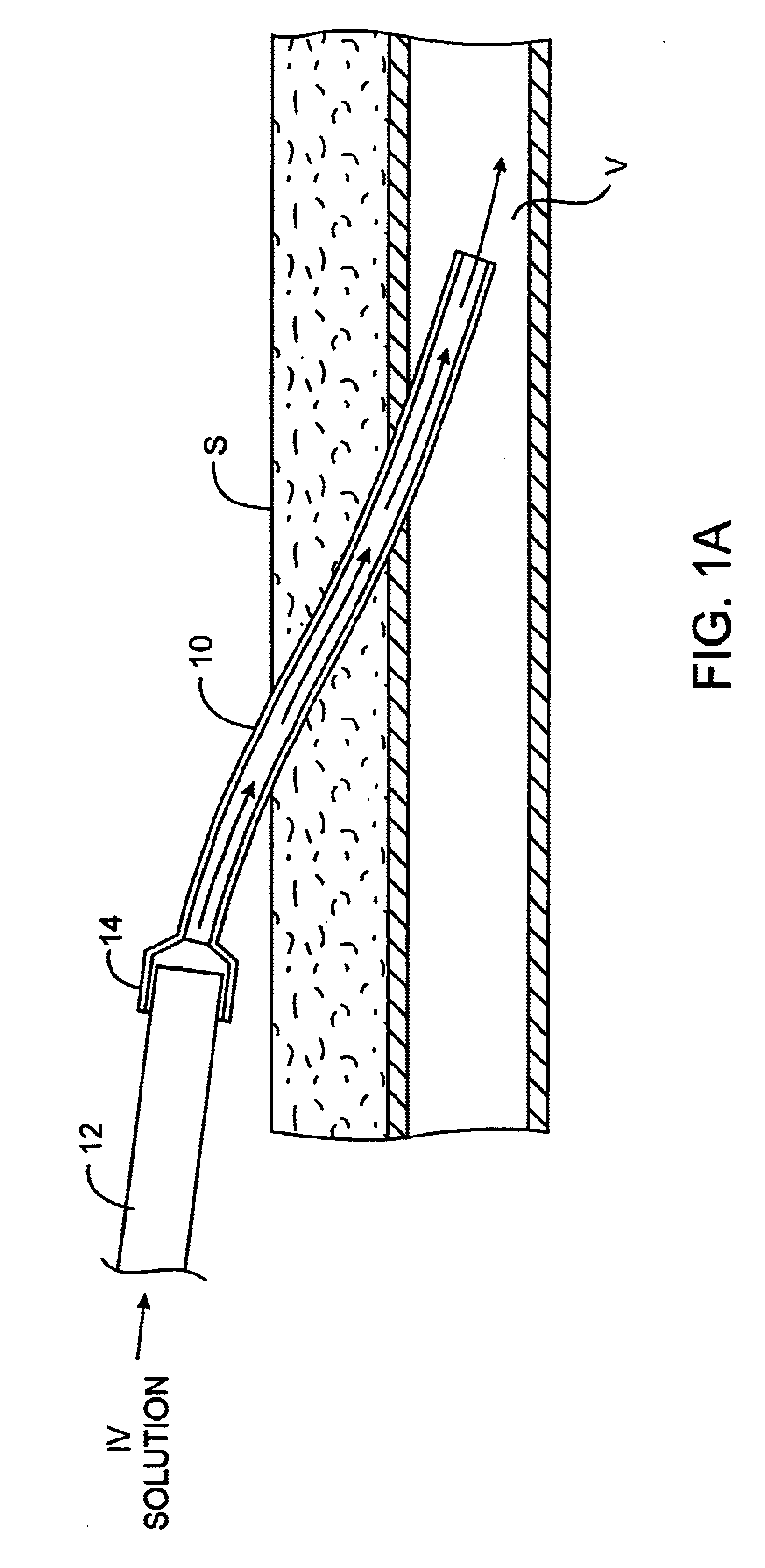 Methods and kits for locking and disinfecting implanted catheters