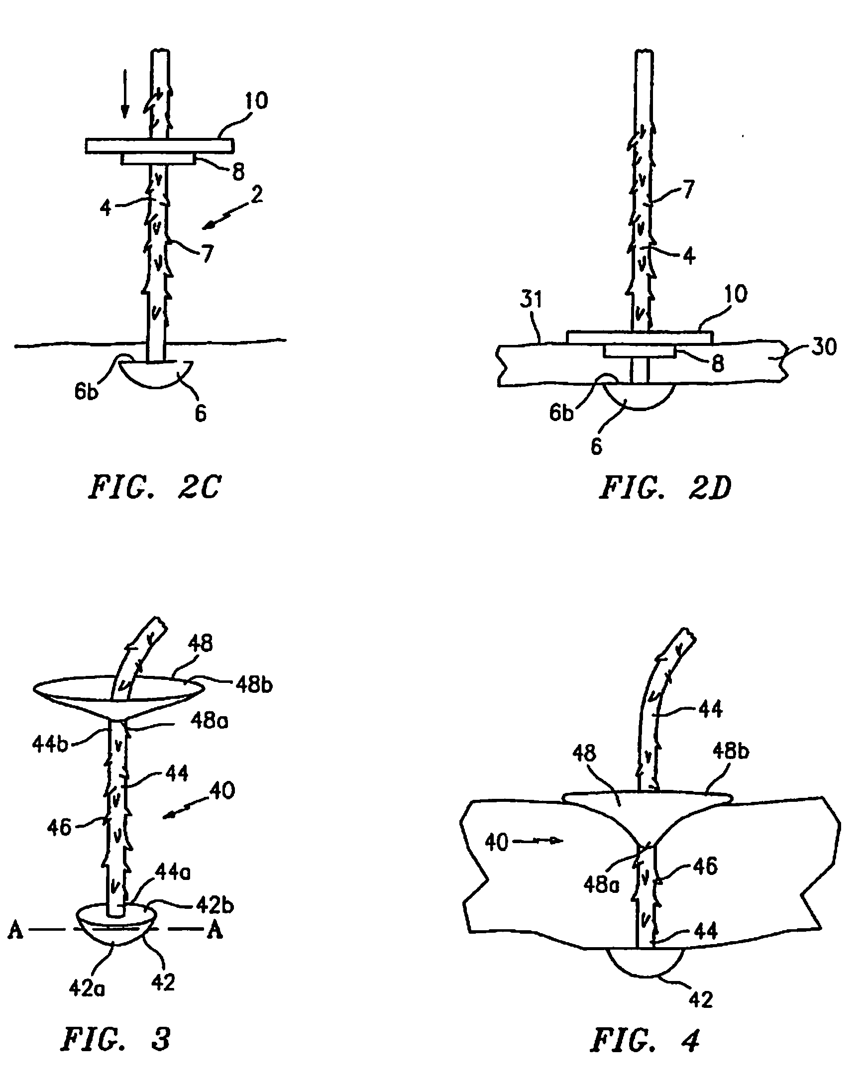 Medical device for wound closure and method of use