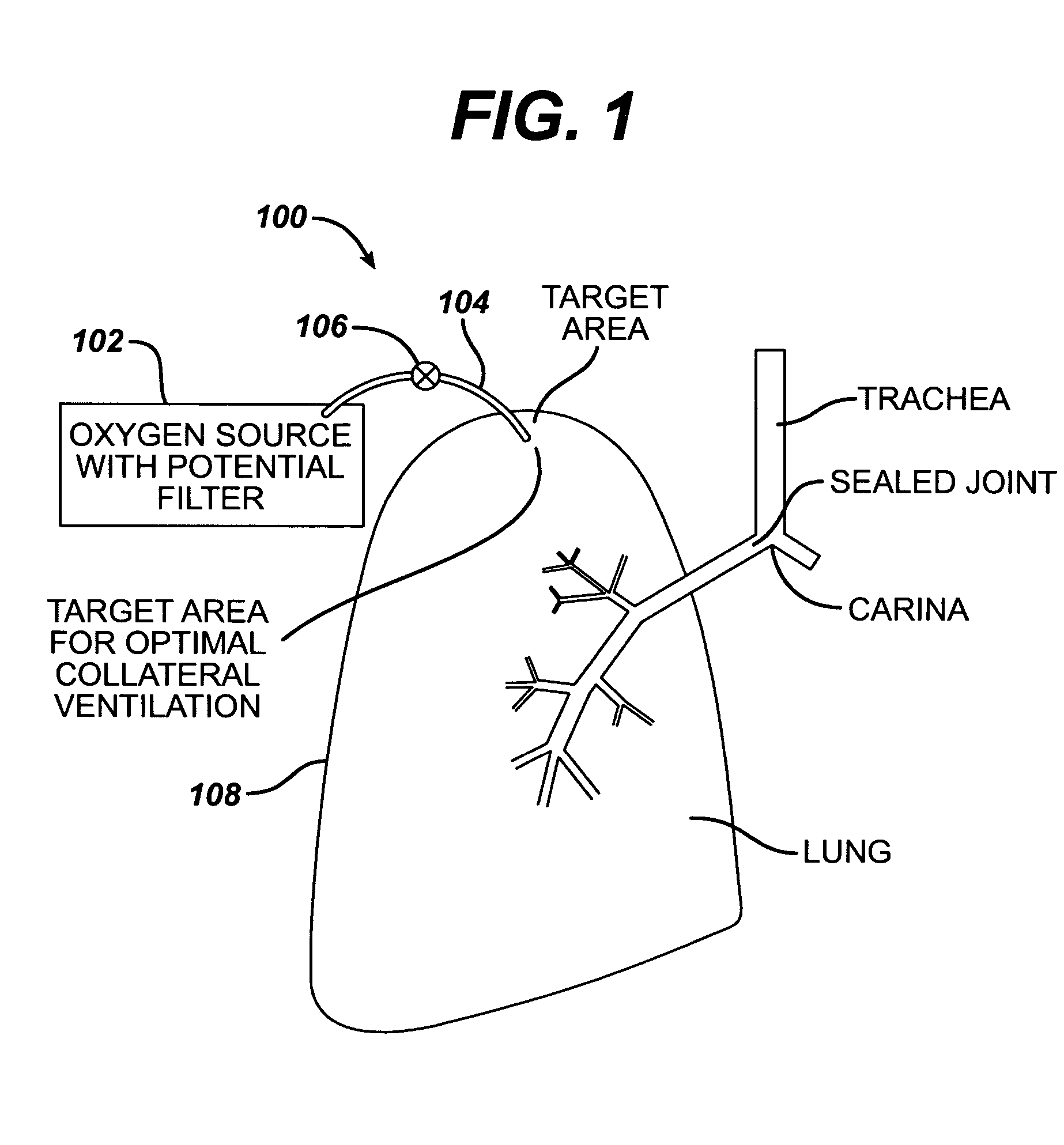 Methods and devices to assist pulmonary decompression