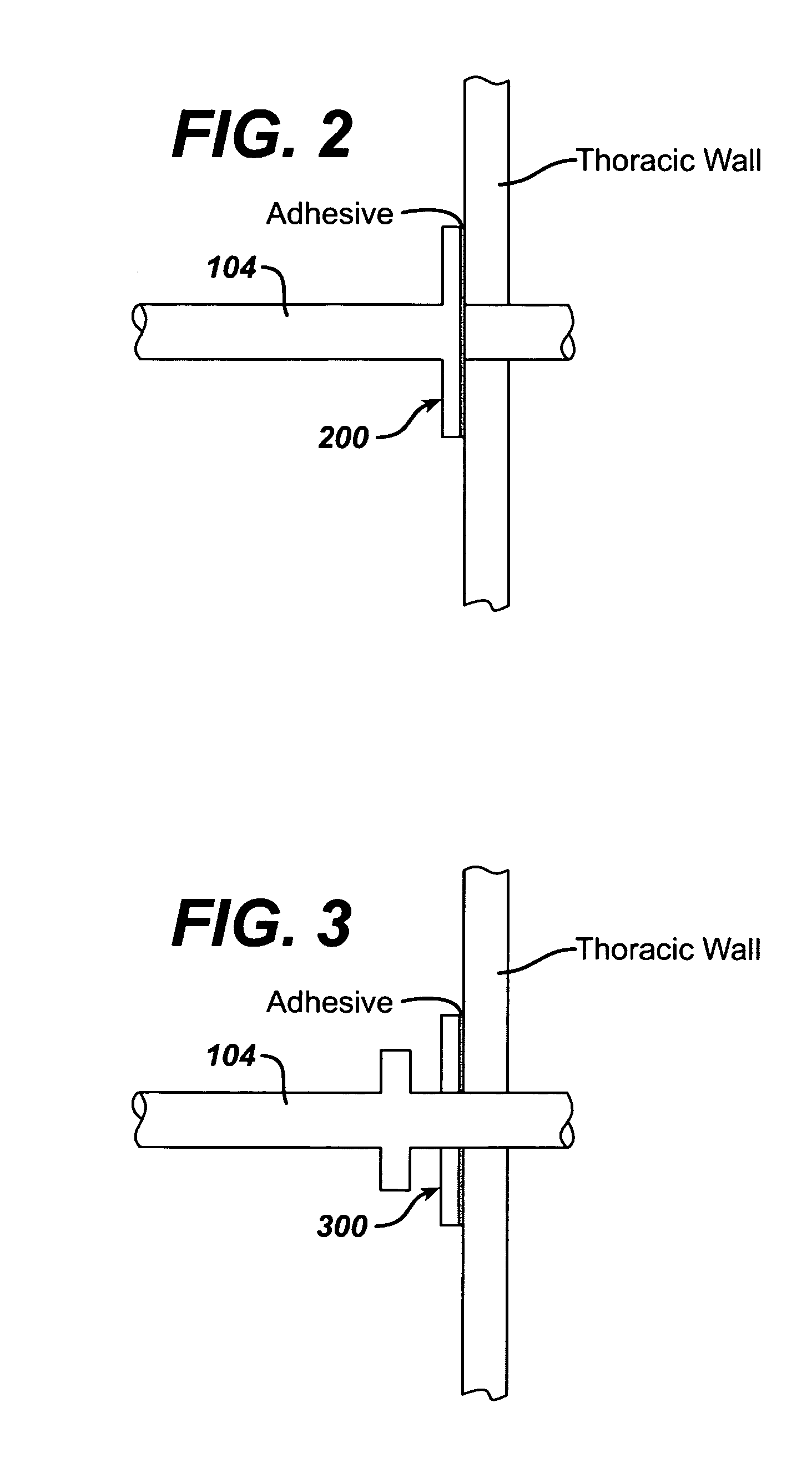 Methods and devices to assist pulmonary decompression