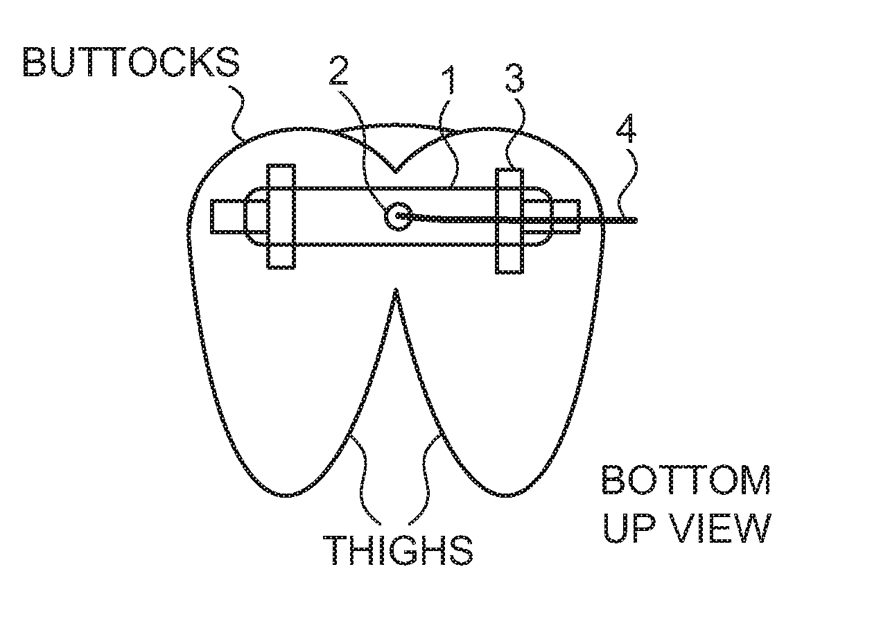 Anal fixation device