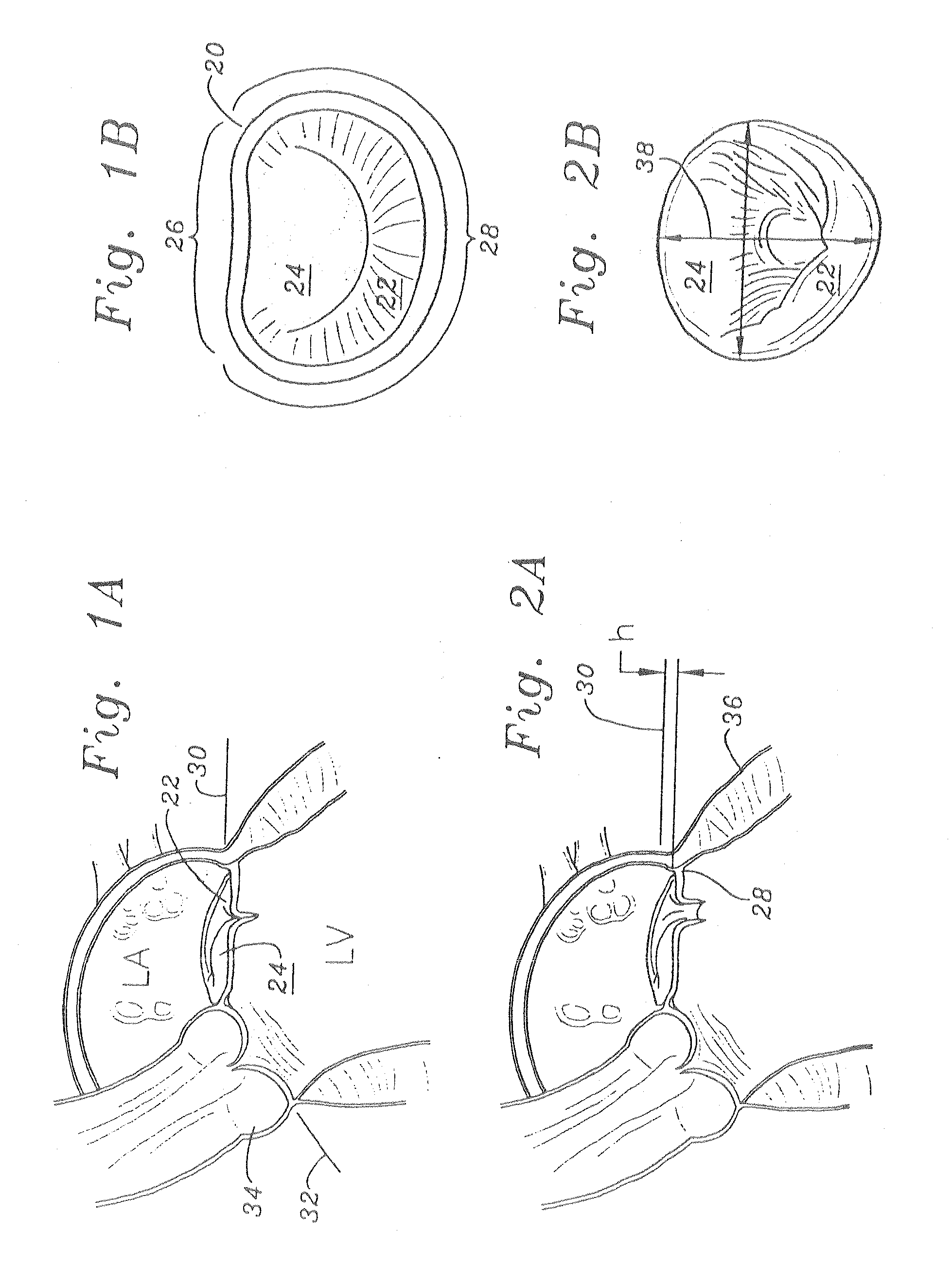 Mitral Annuloplasty Ring Having Upward Bows