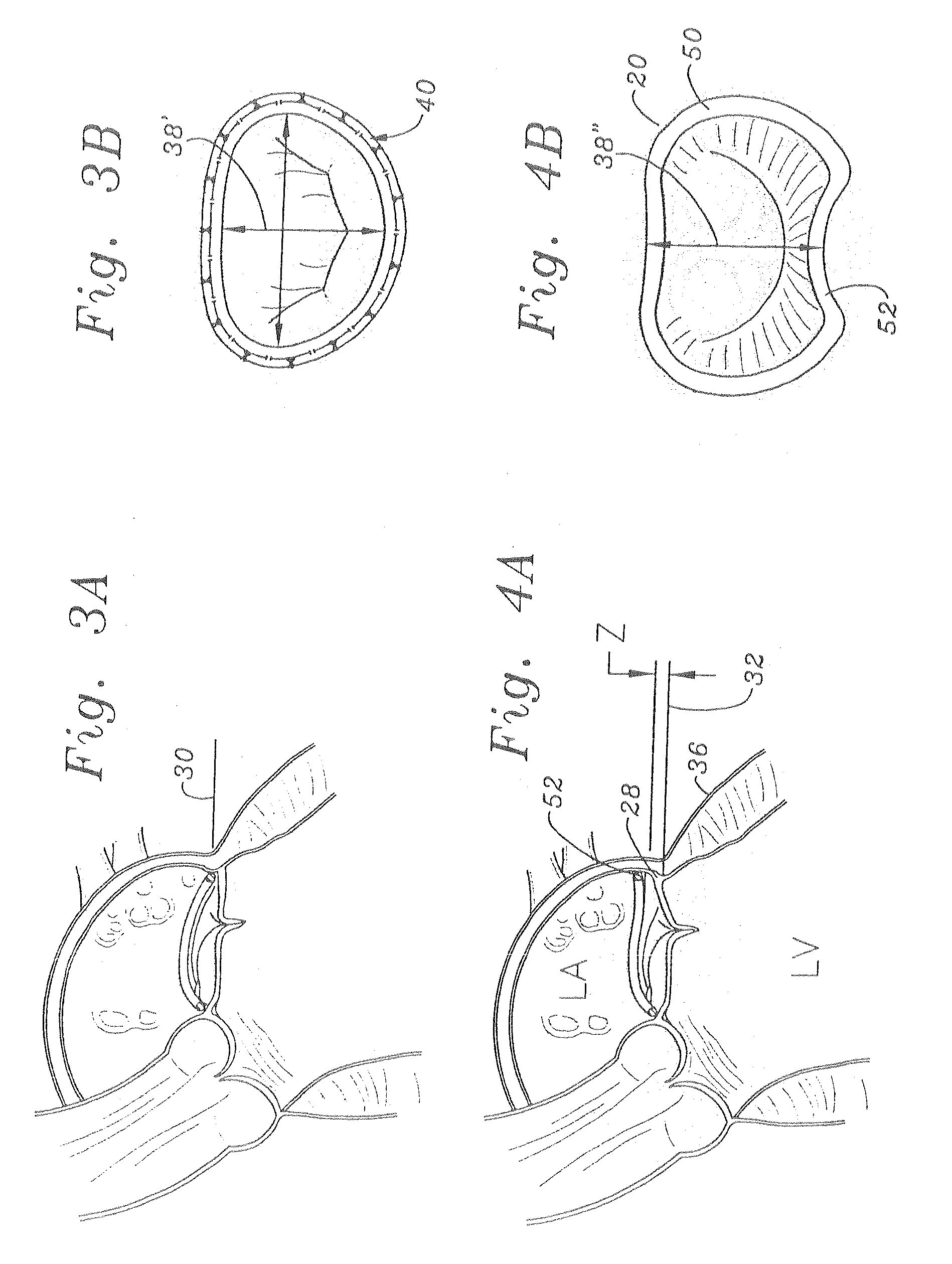 Mitral Annuloplasty Ring Having Upward Bows