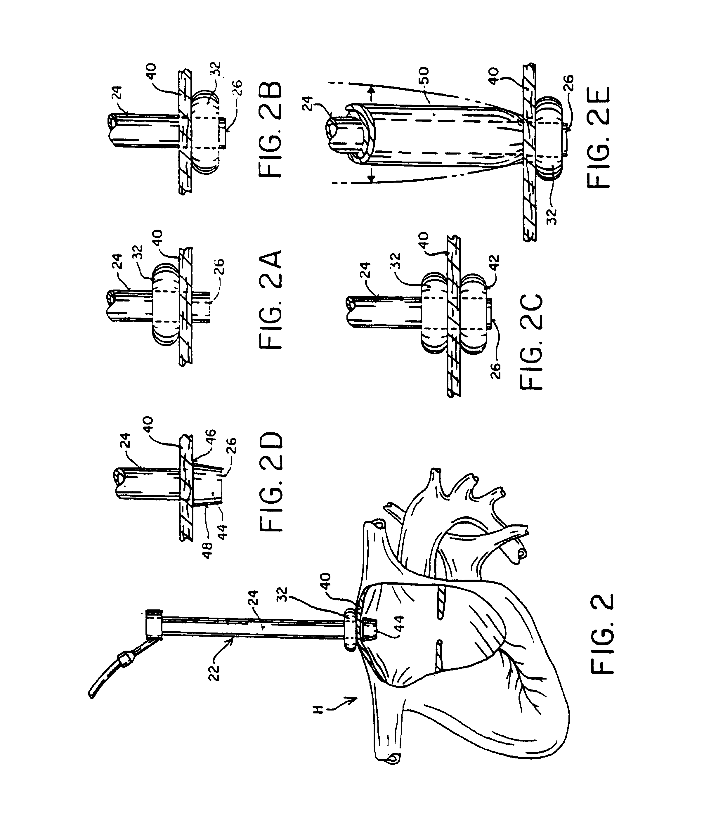 Method of Forming a Lesion in Heart Tissue