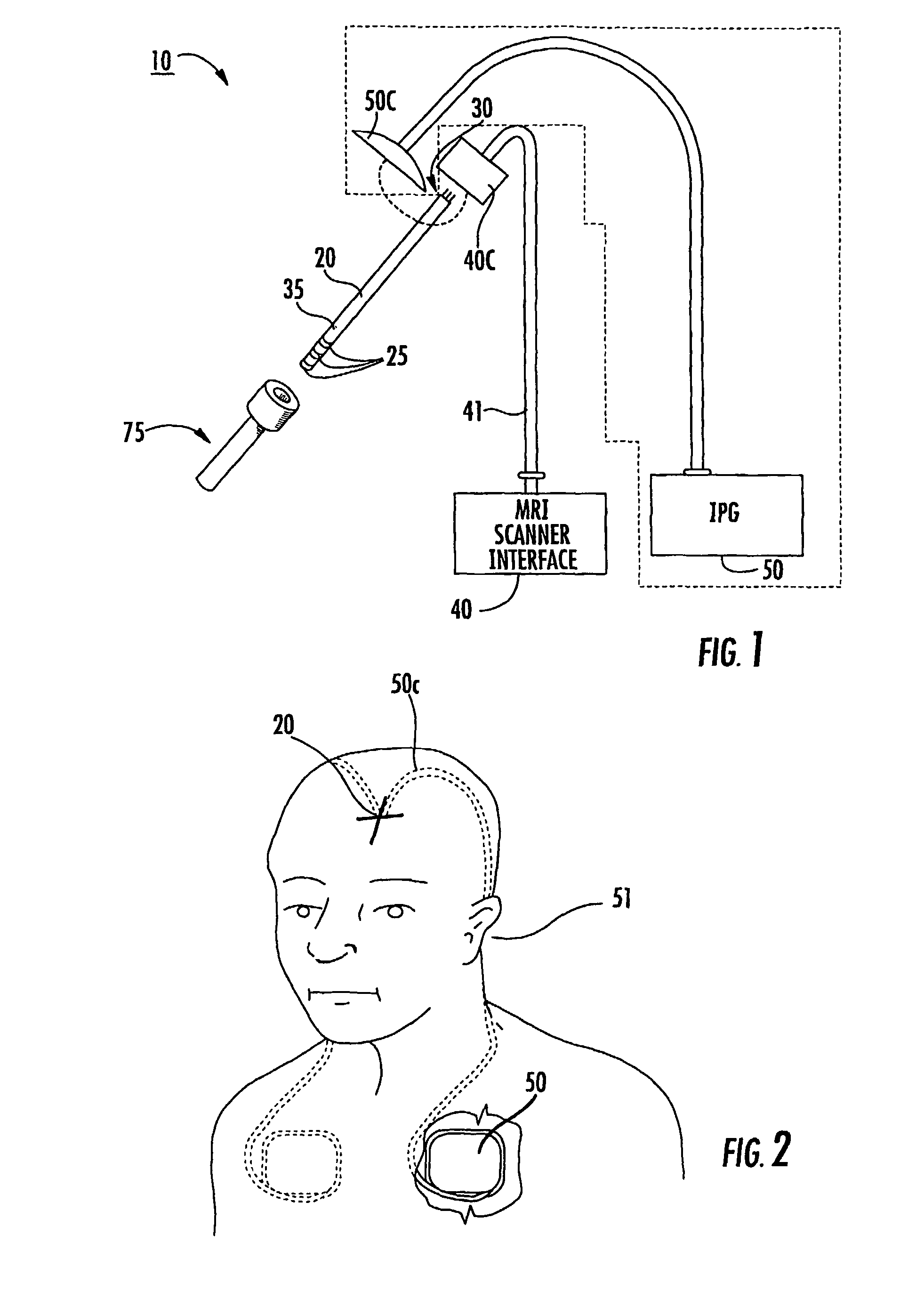 Implantable MRI compatible stimulation leads and antennas and related systems and methods