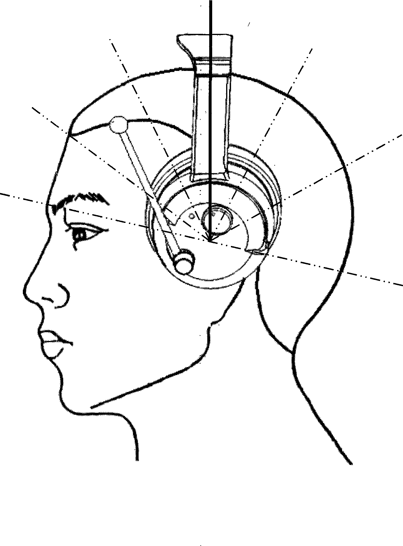 Transcranial magnetoelectric depression therapeutic apparatus
