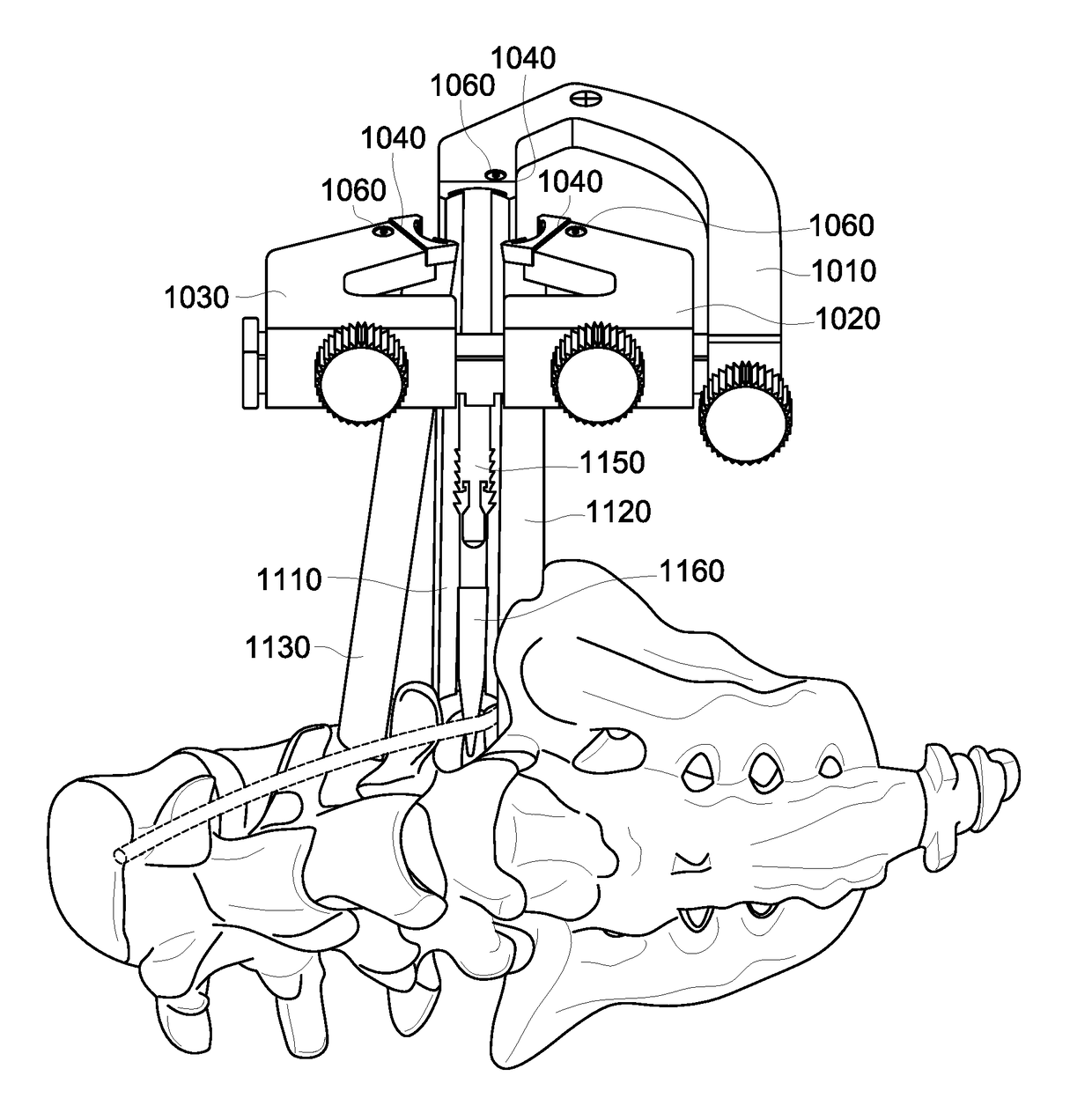 System for Approaching the Spine Laterally and Retracting Tissue in an Anterior to Posterior Direction