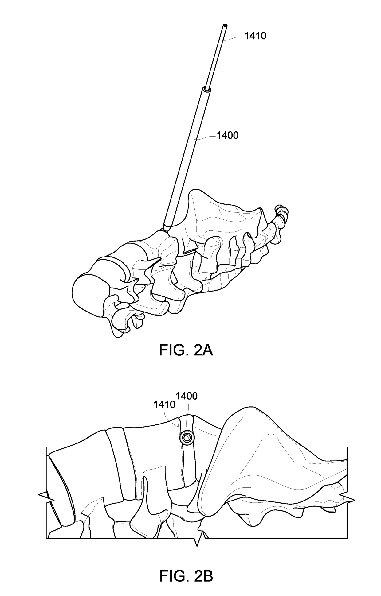 System for Approaching the Spine Laterally and Retracting Tissue in an Anterior to Posterior Direction