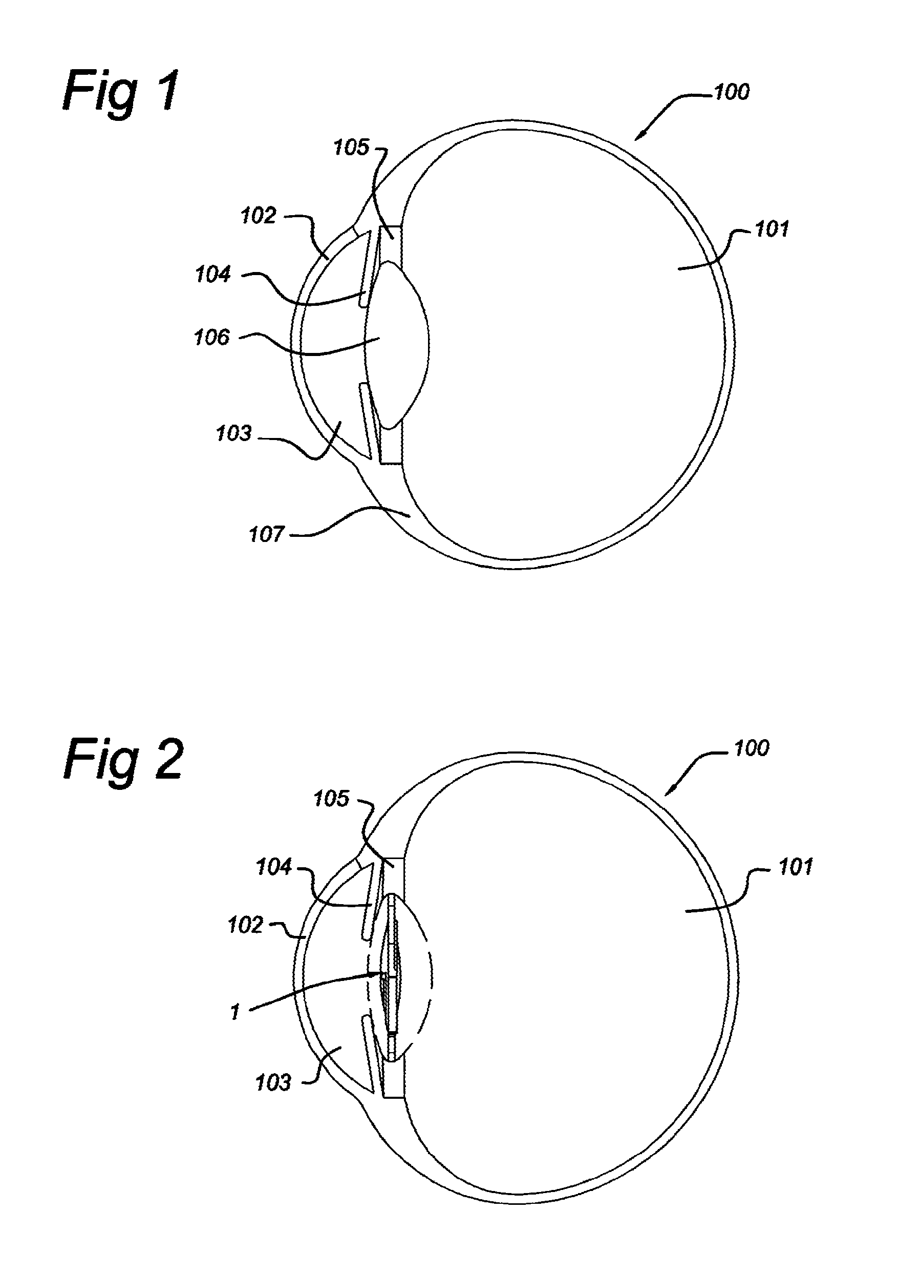 Intra ocular lens