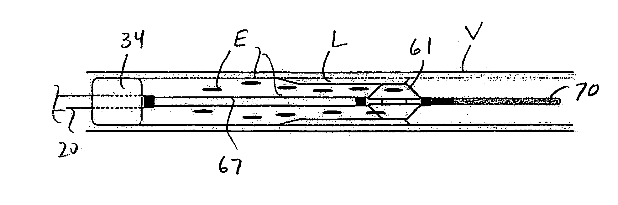 Embolic protection and plaque removal system with closed circuit aspiration and filtering