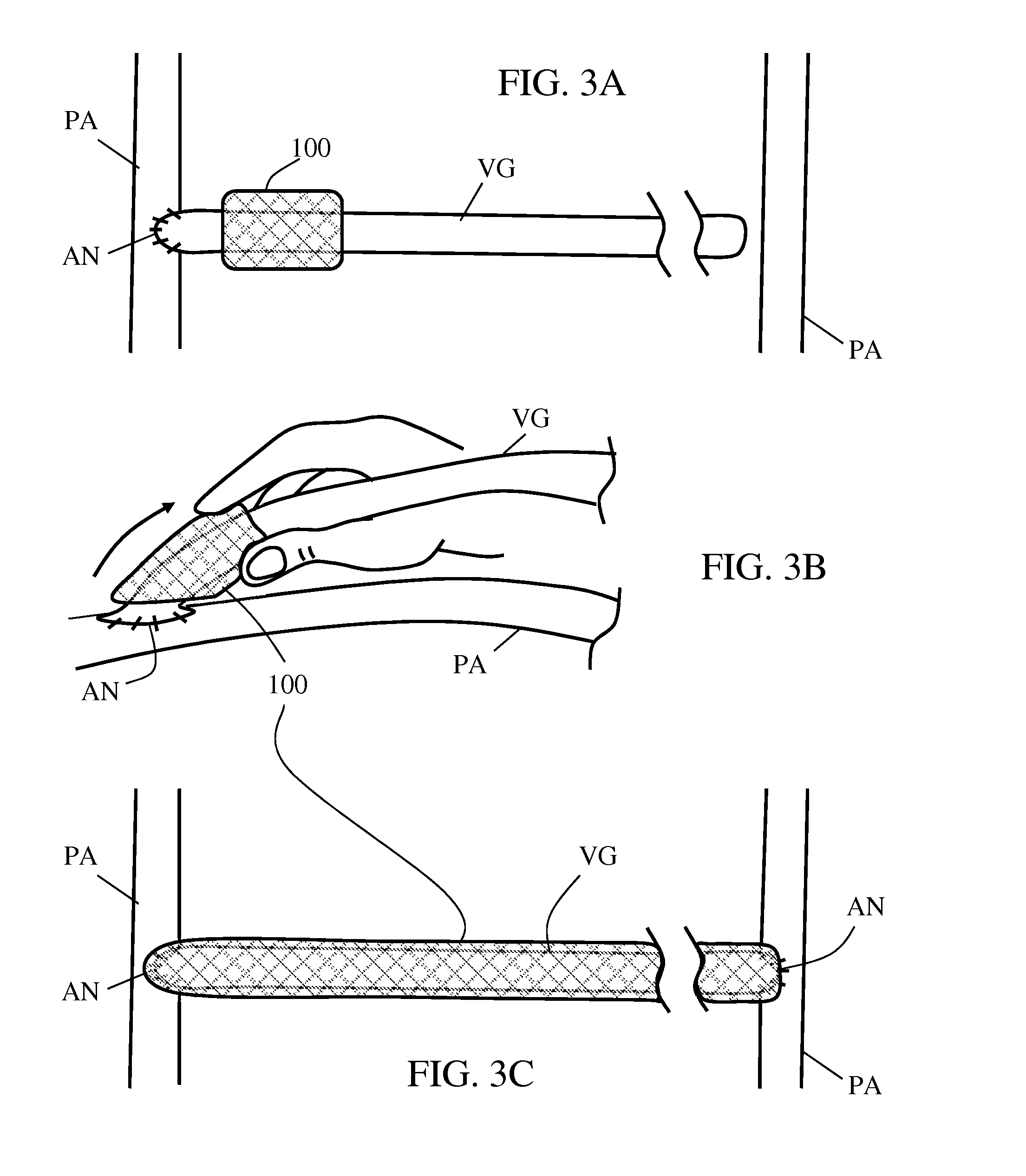 External support for elongated bodily vessels