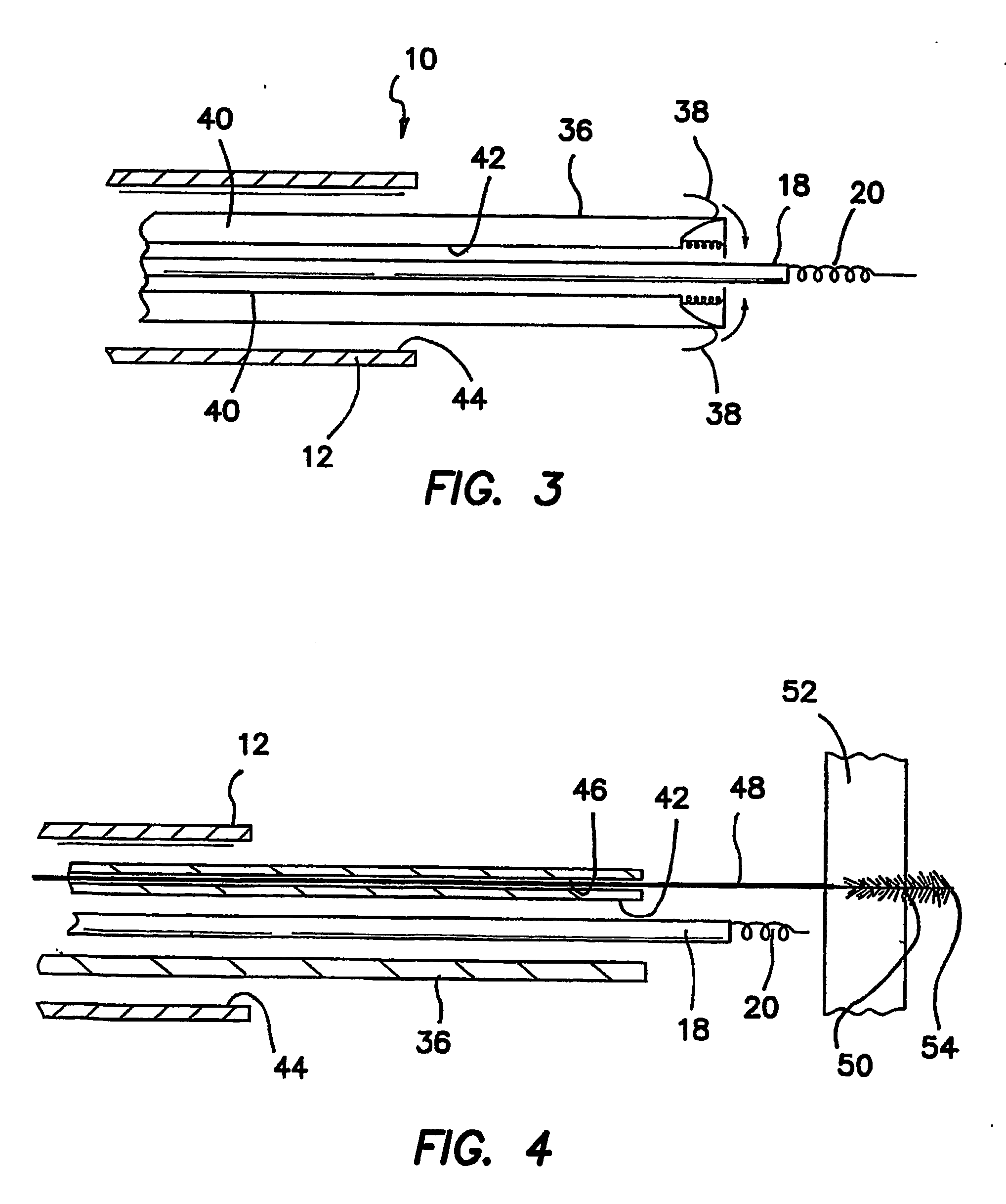 Method and apparatus for anchoring of pacing leads