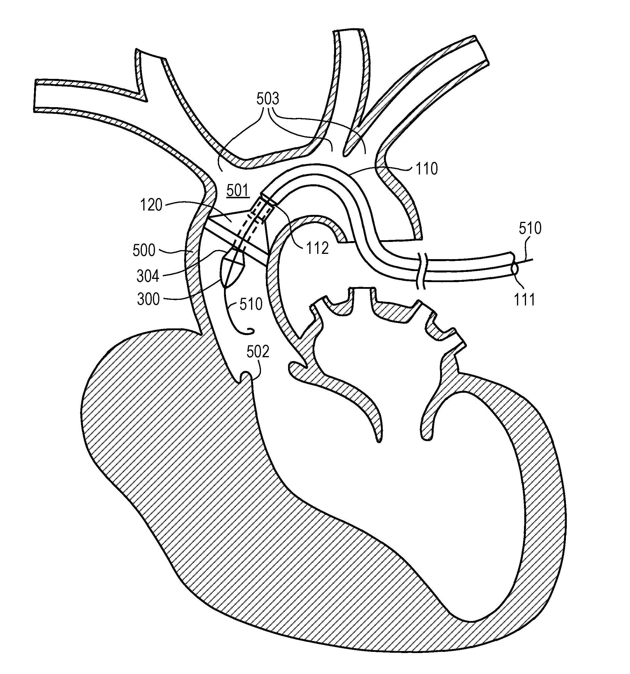Apparatus and methods for filtering emboli during precutaneous aortic valve replacement and repair procedures with filtration system coupled to distal end of sheath