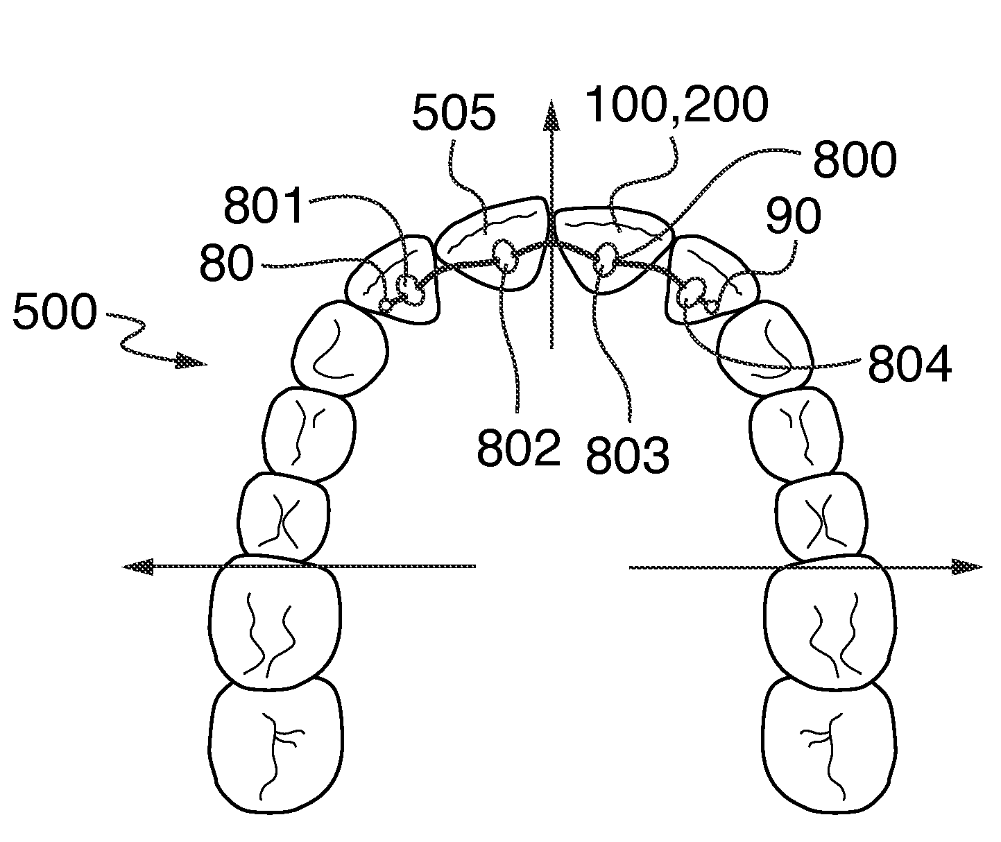 Orthodontic Wire Alignment System and Method