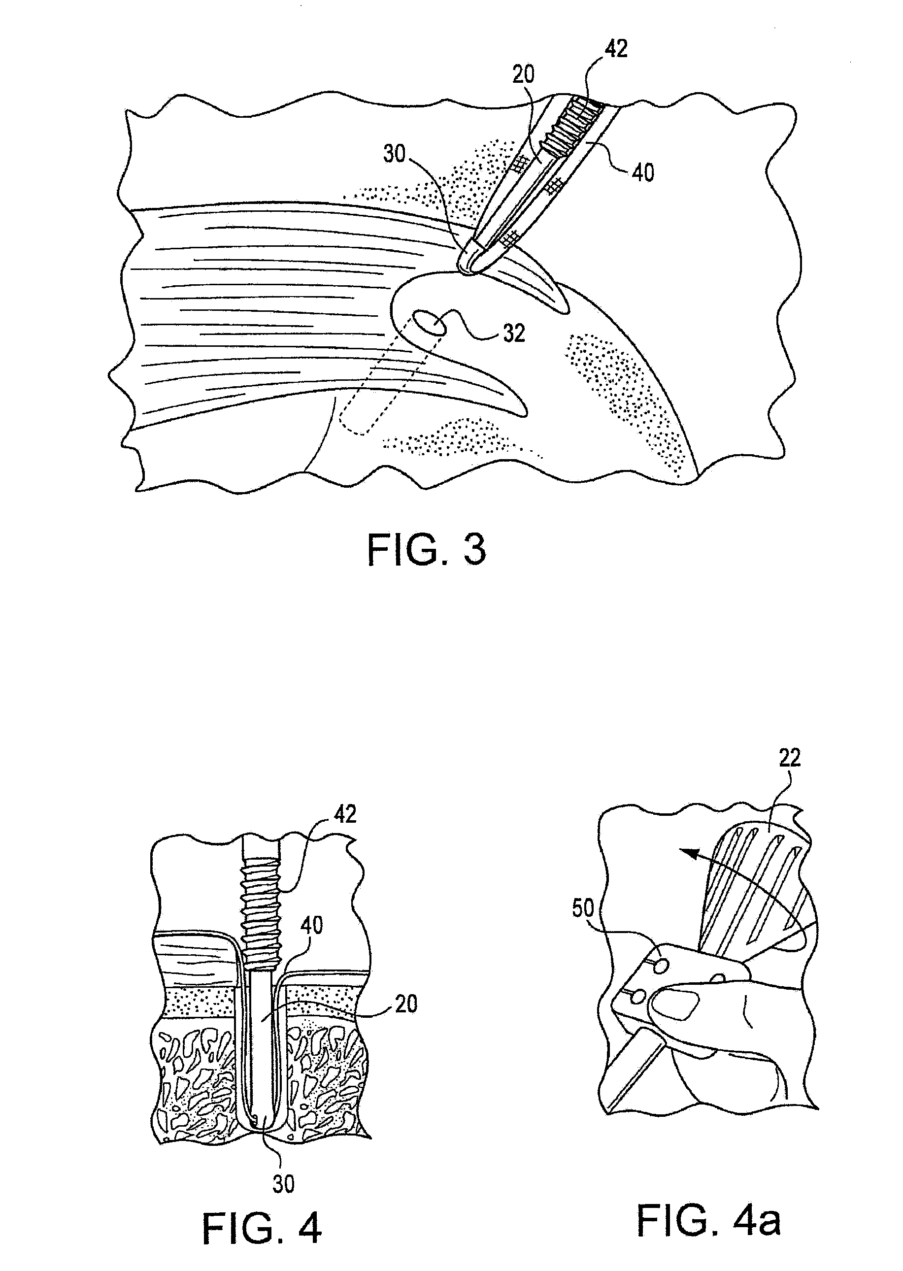 Fenestrated swivel anchor for knotless fixation of tissue