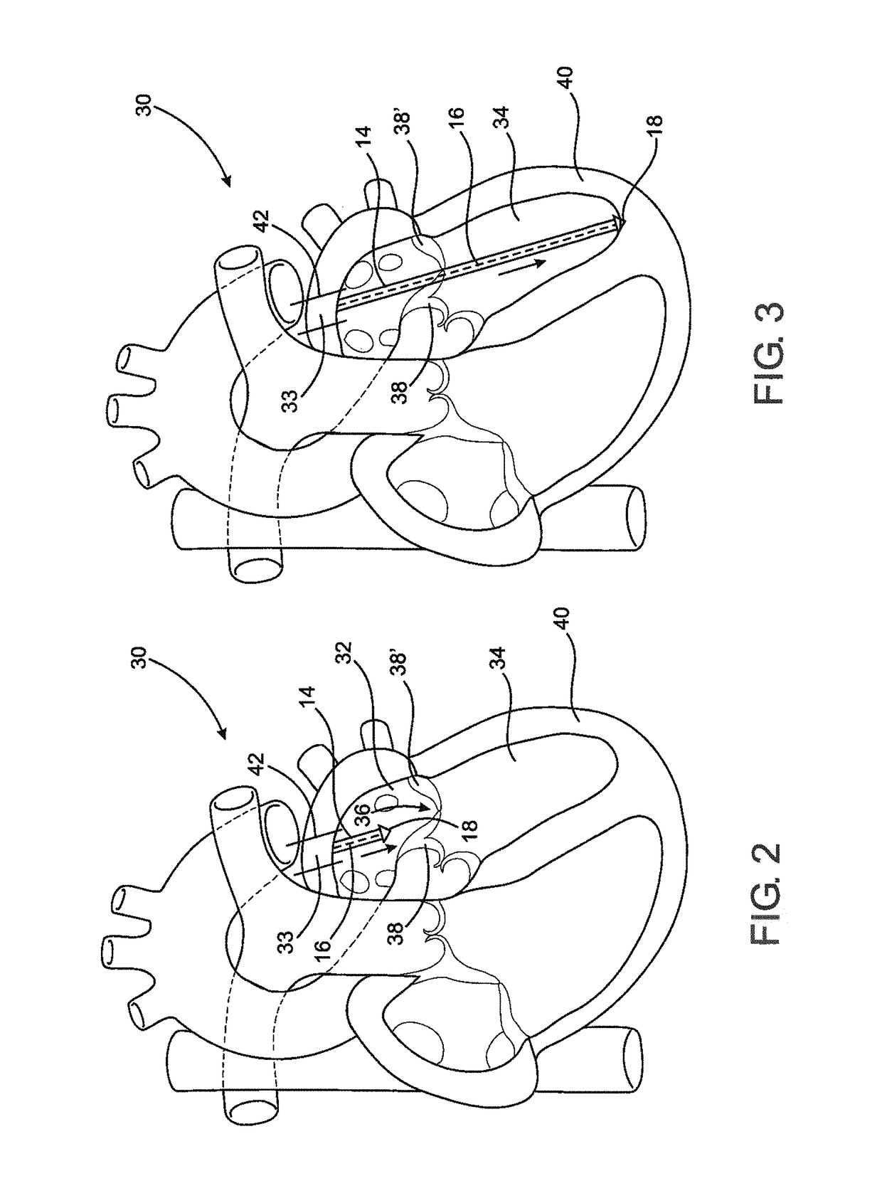 Device and method of treating heart valve malfunction