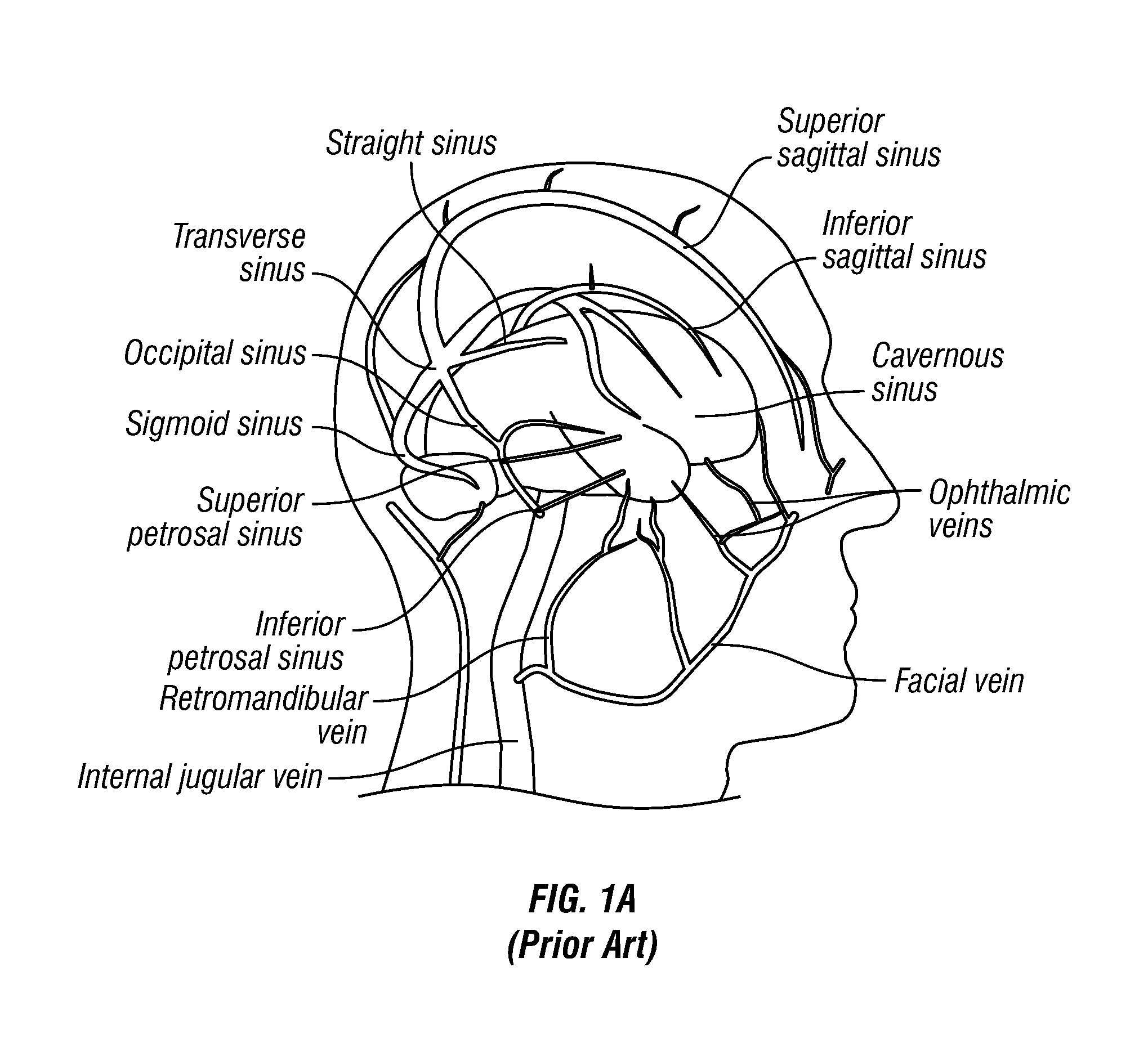 Methods, Systems and Devices for Treatment of Cerebrospinal Venous Insufficiency and Multiple Sclerosis