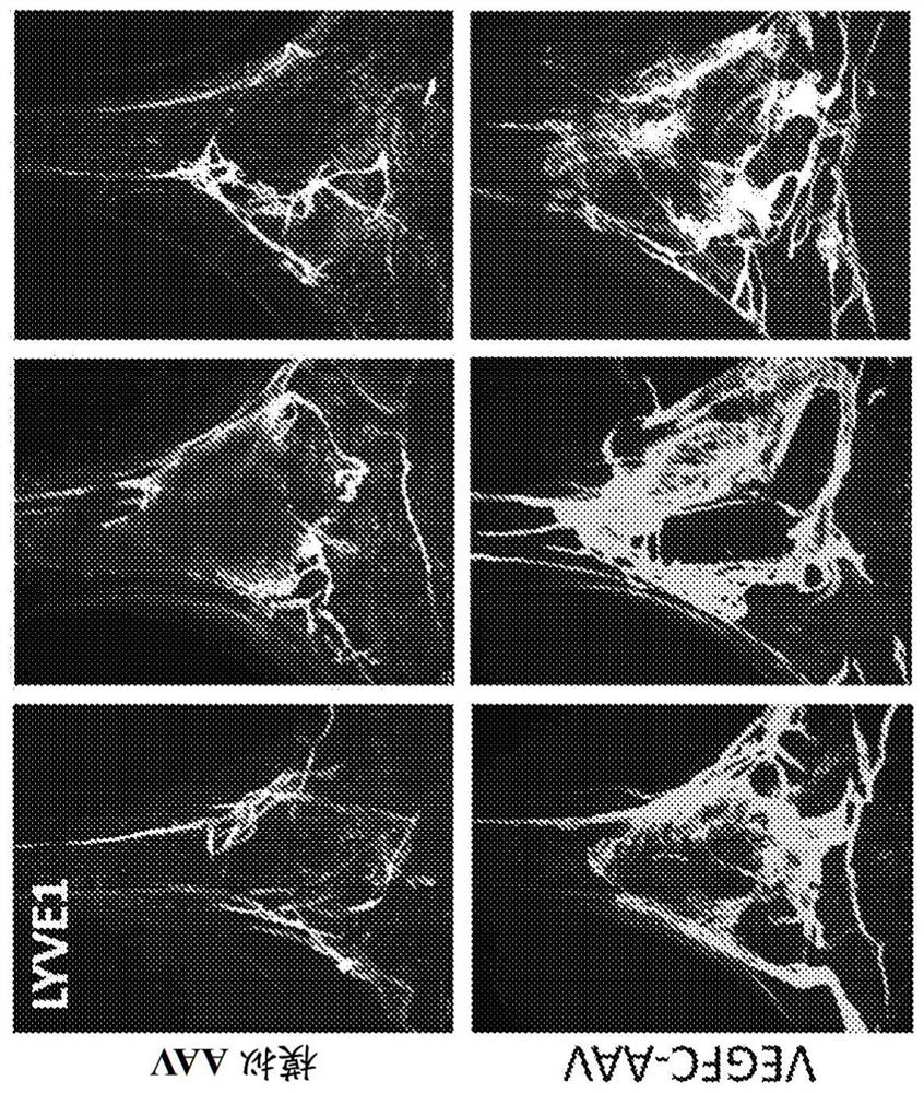 Manipulation of meningeal lymphatic vasculature for brain and CNS tumor therapy