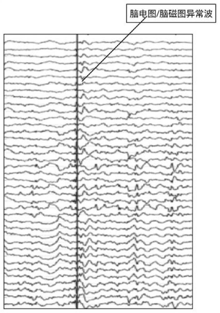 Automatic detection method for epilepsy electroencephalography (EEG)/magnetoencephalography (MEG) abnormal waves and positioning system