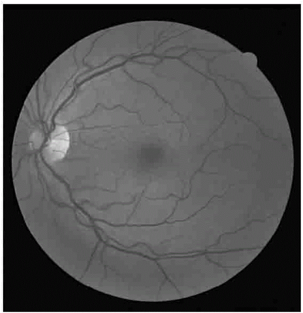 Fundus image classification method and device of retinopathy