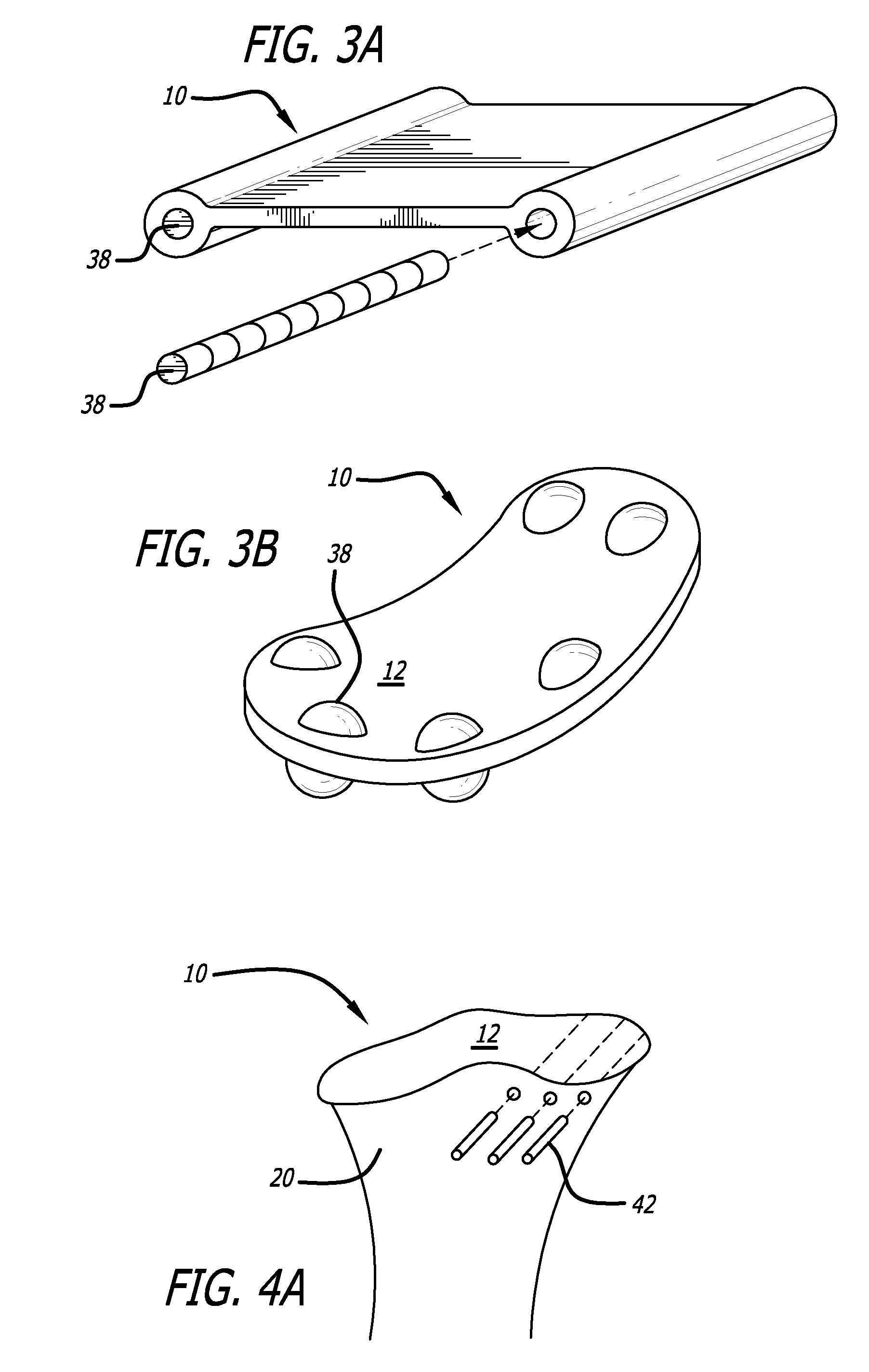 Joint support and subchondral support system