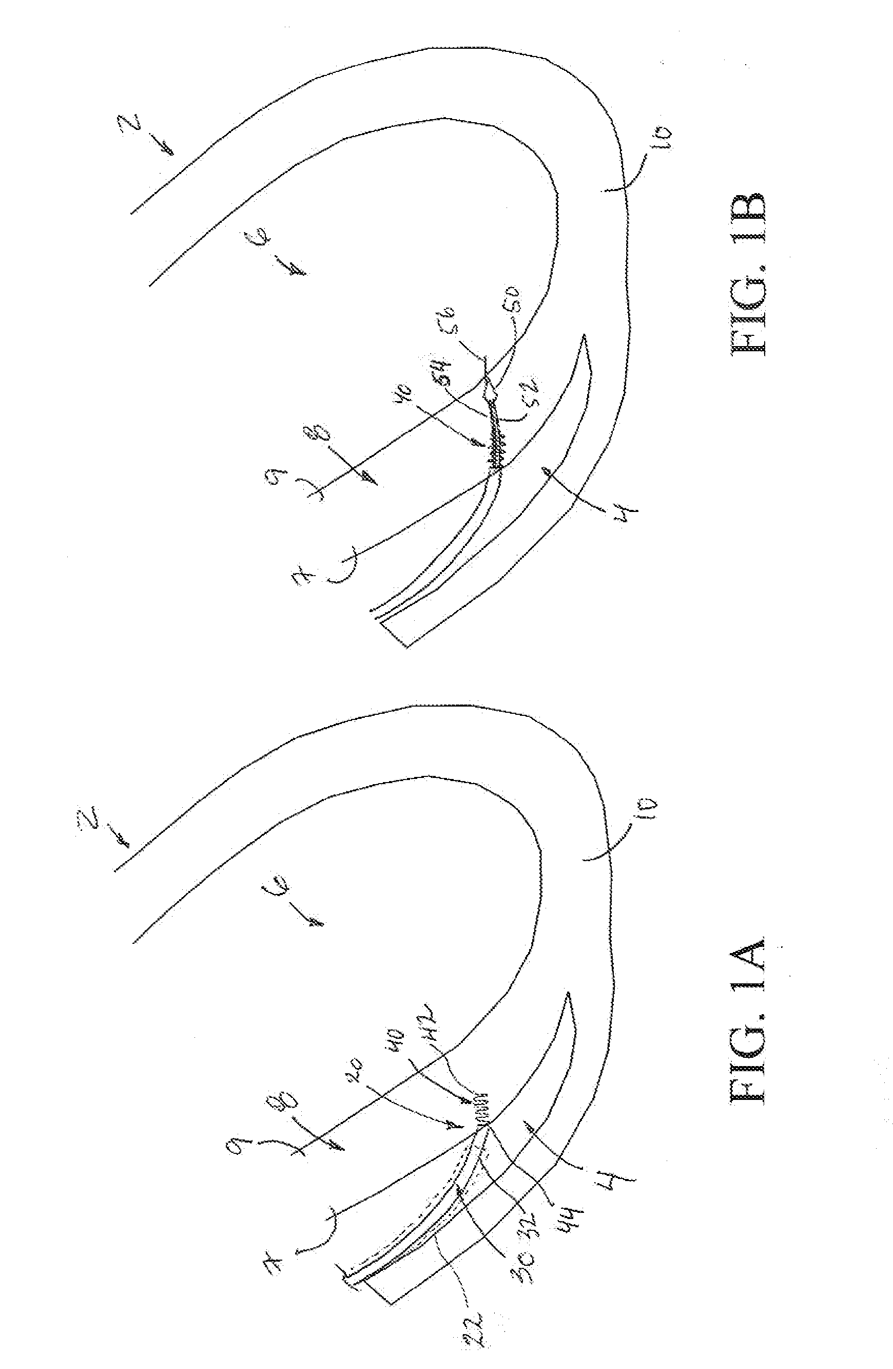 Transmuscular left ventricular cardiac stimulation leads and related systems and methods